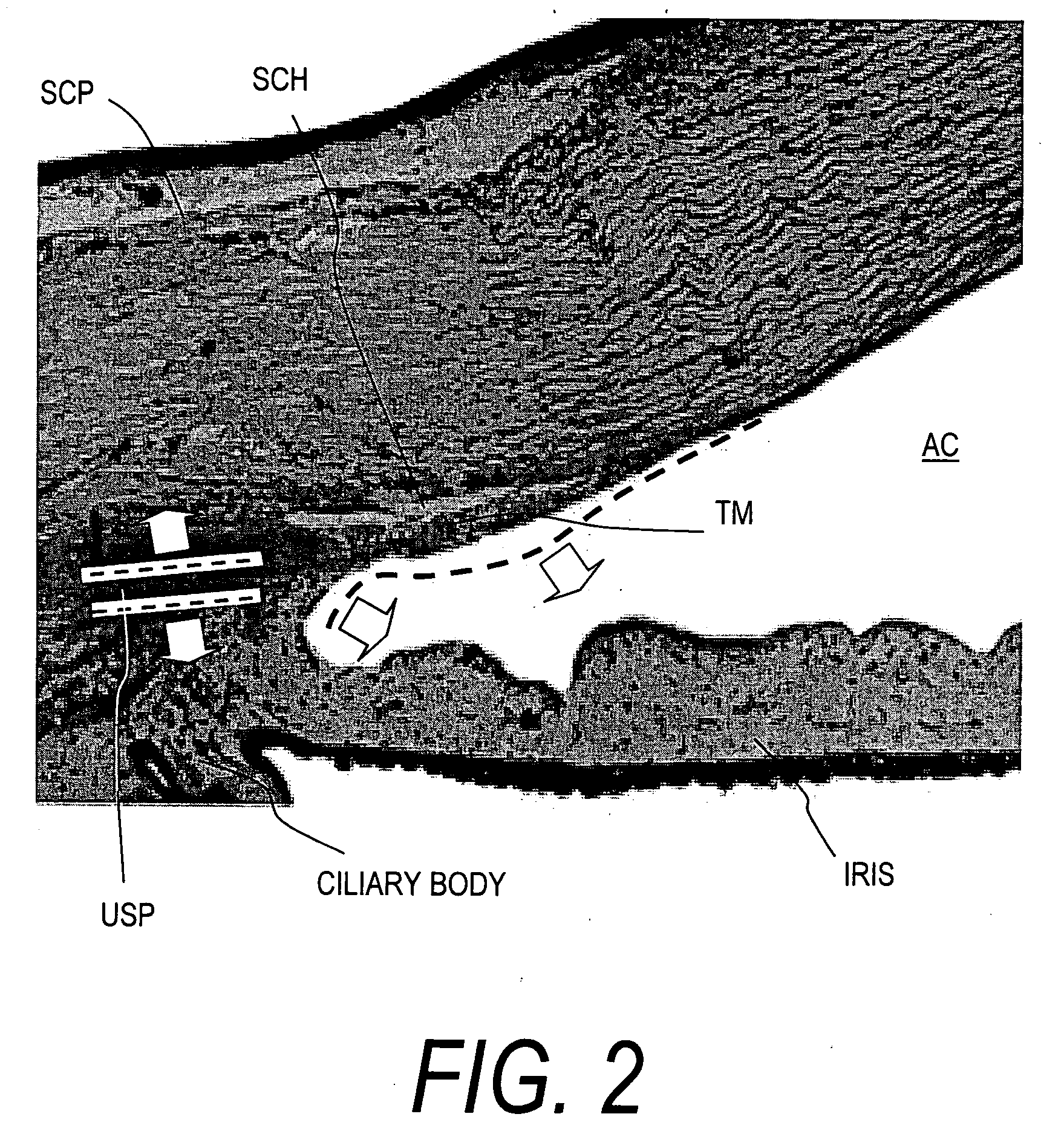 Implants for treating ocular hypertension, methods of use and methods of fabrication