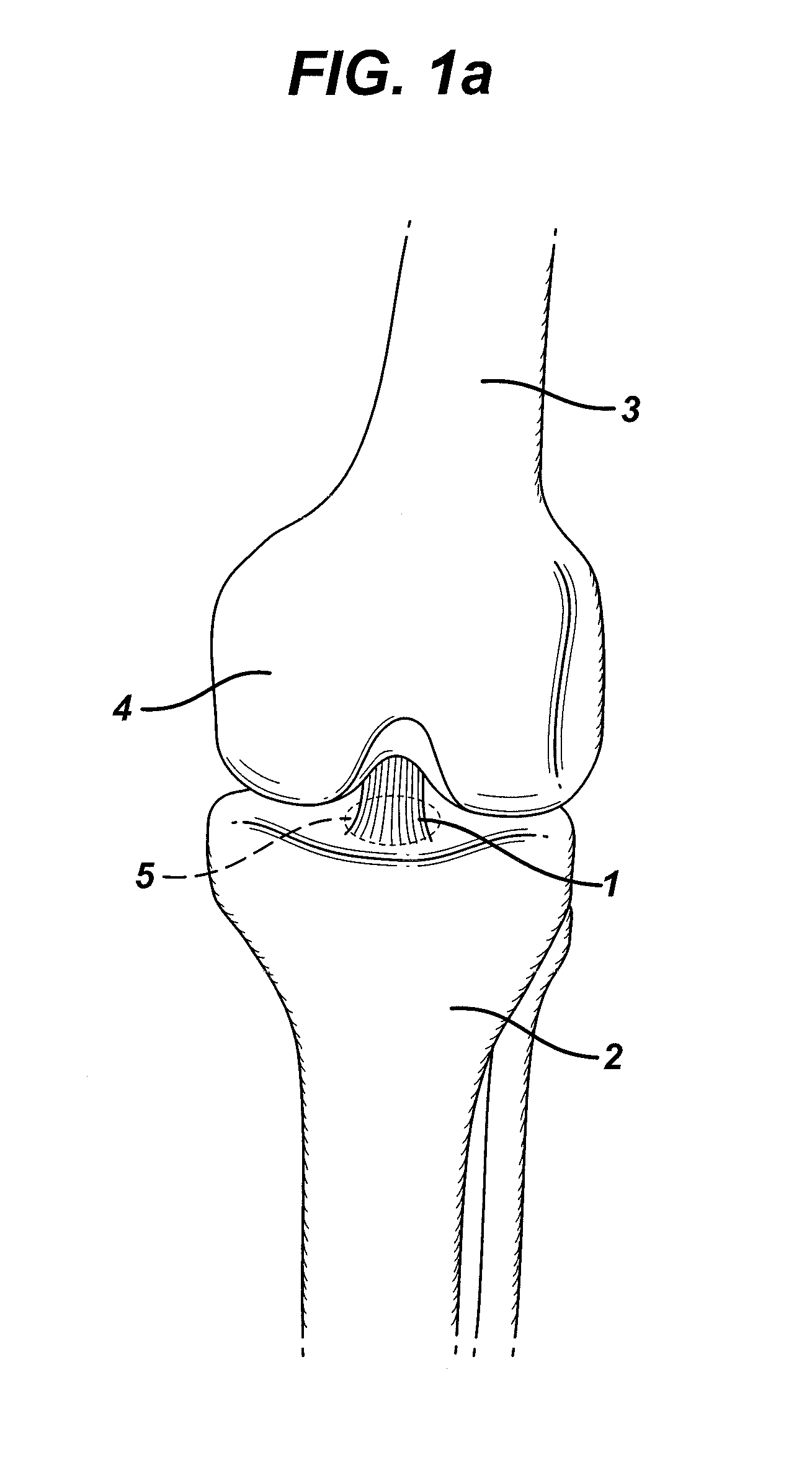 Method of anchoring autologous or artificial tendon grafts in bone