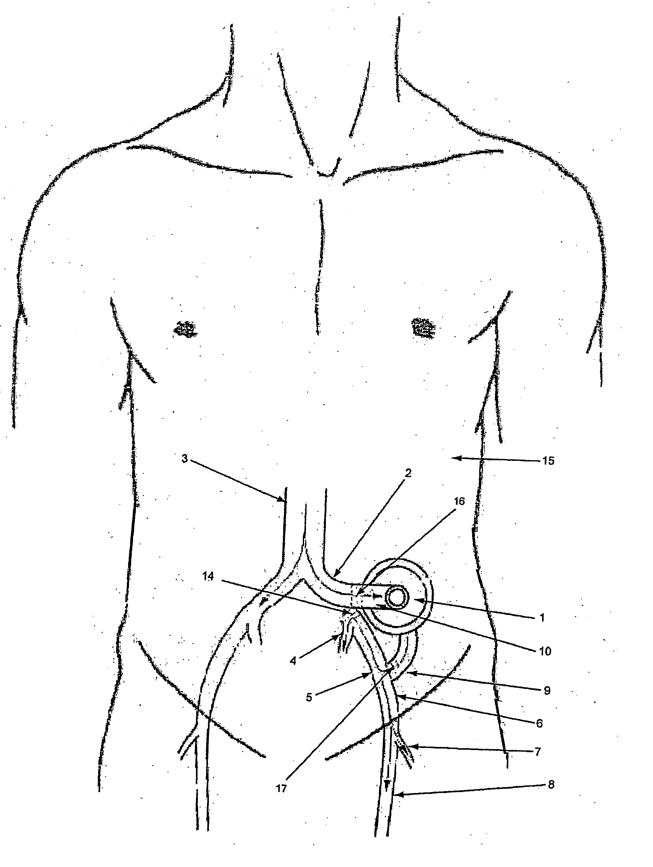 Blood pumping system and procedure
