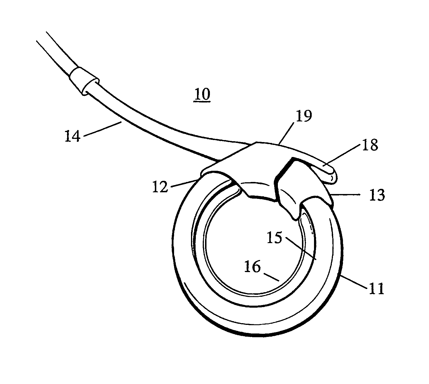 Remotely adjustable gastric banding method