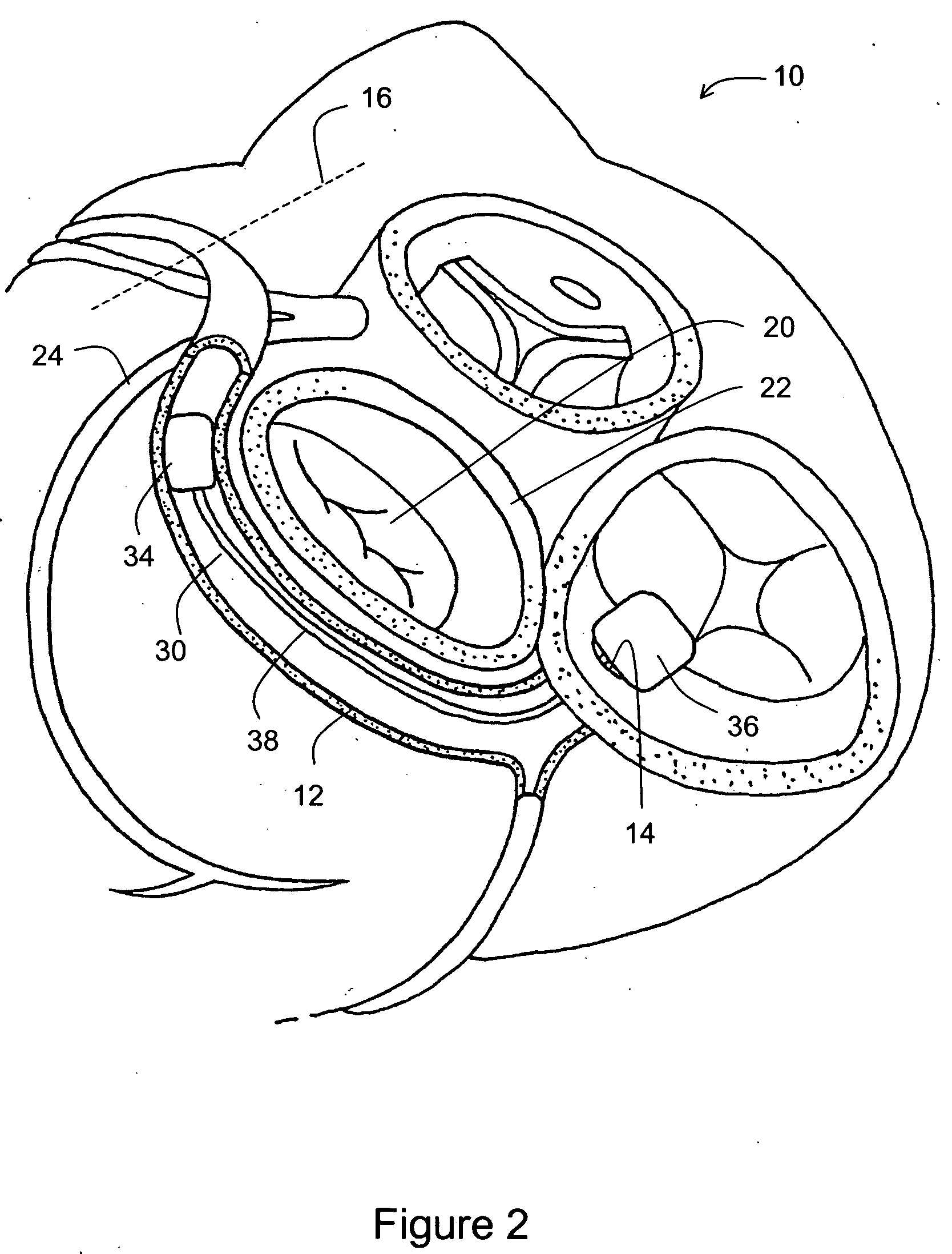 Reduced length tissue shaping device