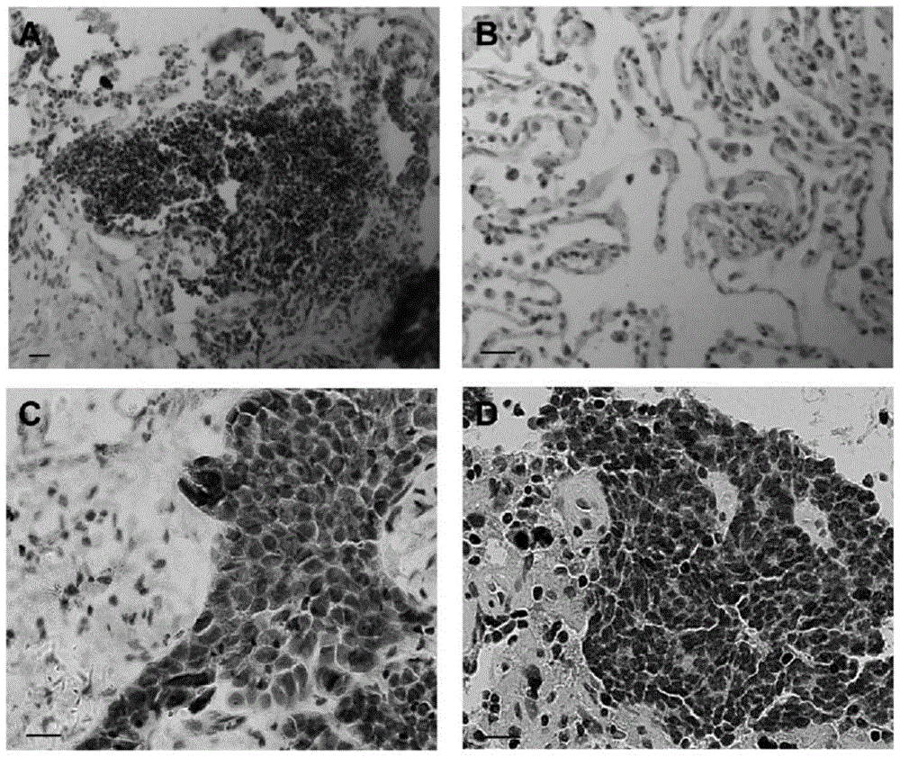 Application and kit of gene ikzf3 in preparation of lung cancer diagnostic kit