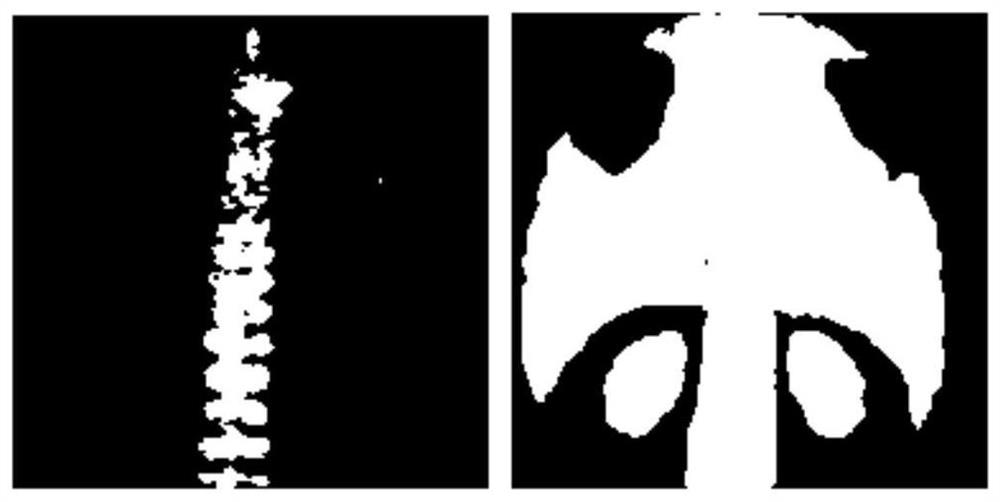 Bone scan image hot spot segmentation method, system, medium and device