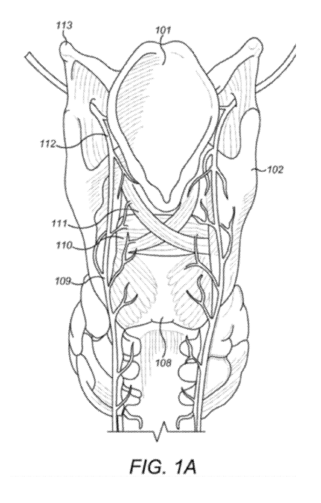 Respiratory Triggered Parasternal Electromyographic Recording In Neurostimulators