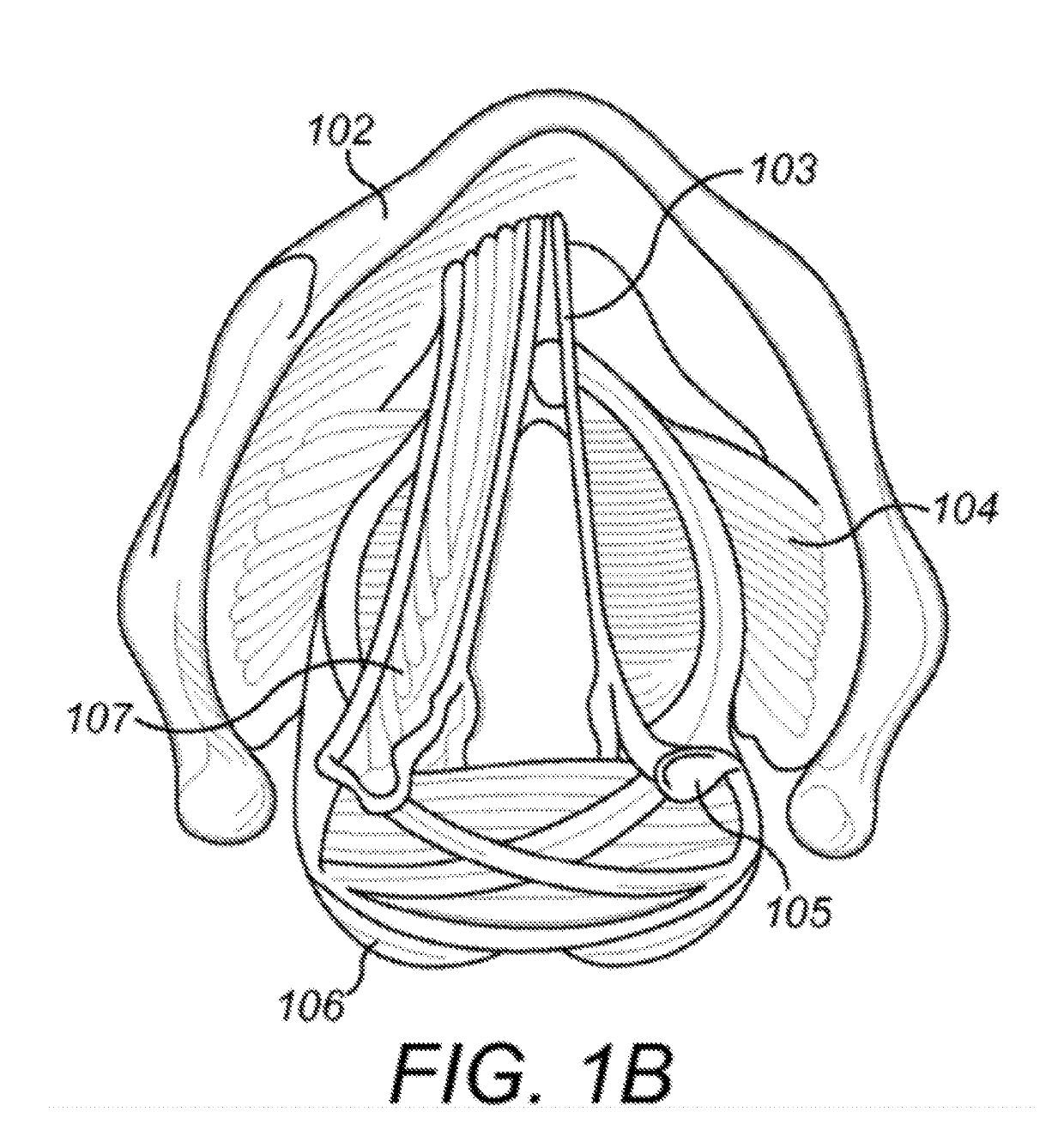 Respiratory Triggered Parasternal Electromyographic Recording In Neurostimulators