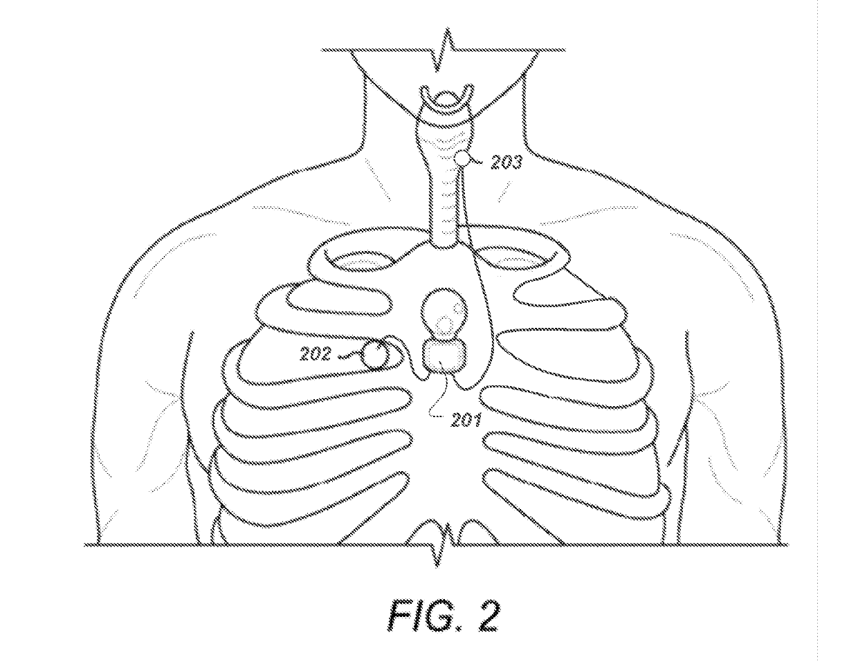 Respiratory Triggered Parasternal Electromyographic Recording In Neurostimulators