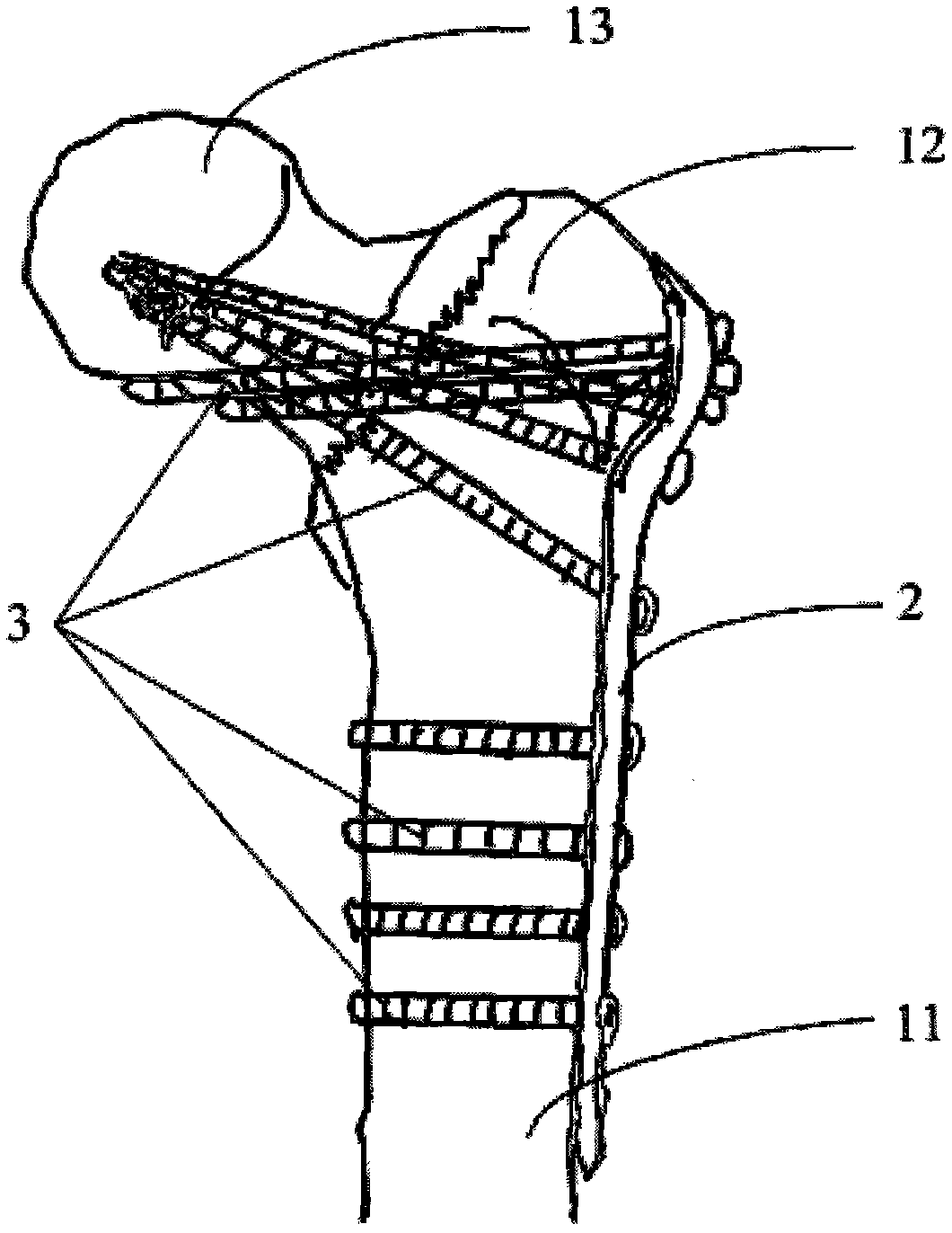Proximal femoral anti-rotation locking device