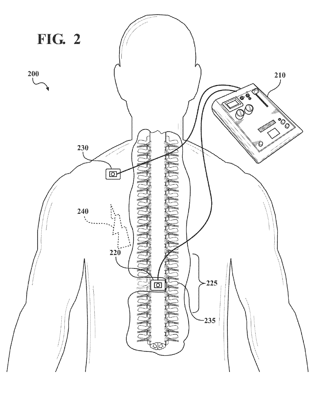 Transcutaneous spinal cord stimulation for treatment of psychiatric disorders