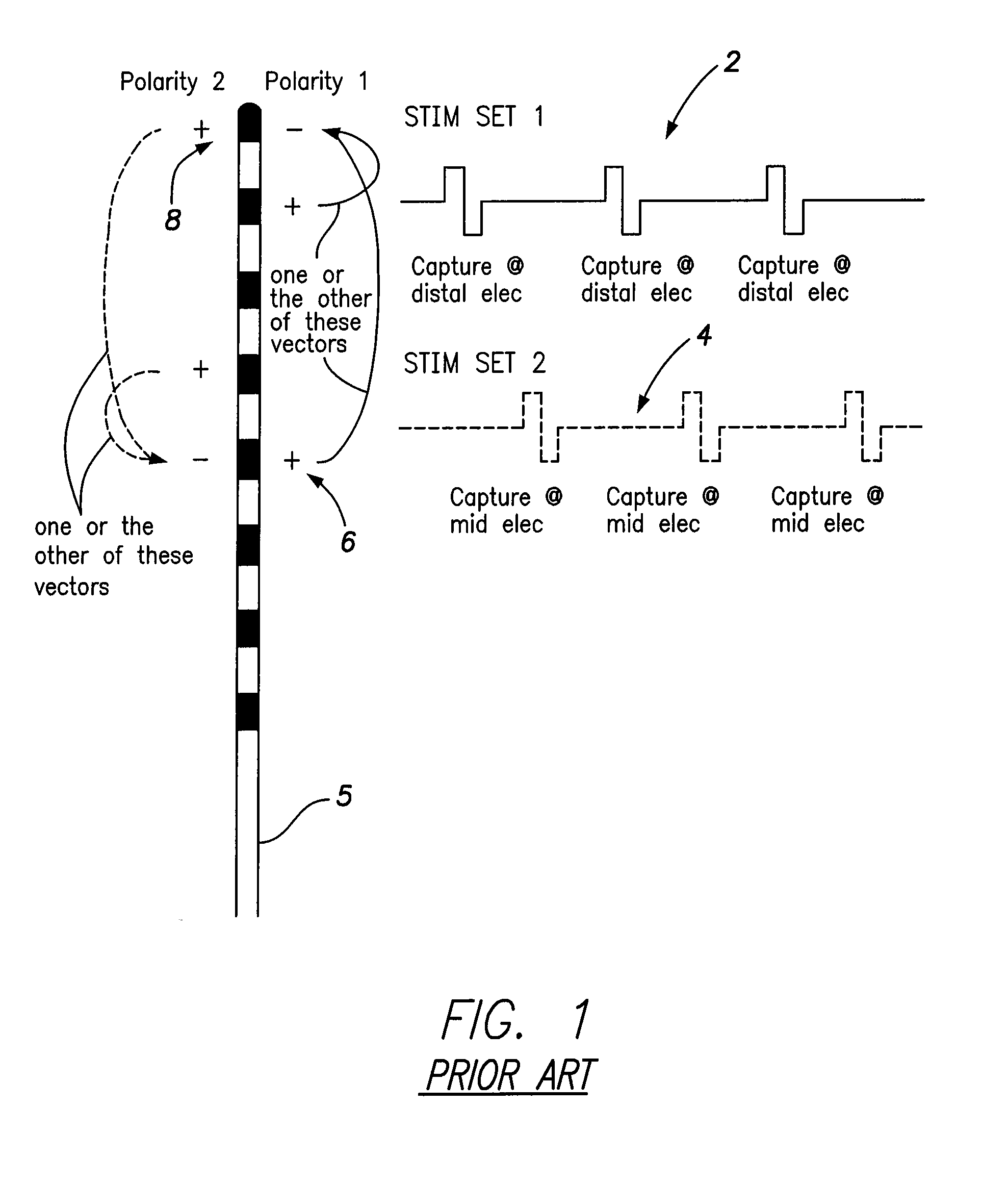 Systems and methods for providing a distributed virtual stimulation cathode for use with an implantable neurostimulation system