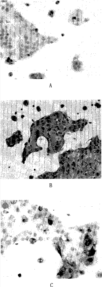 A human pancreatic cancer cell line resistant to gemcitabine and its application