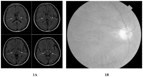 Specific induced pluripotent stem cell line containing CLCN2 homozygous mutation for leukoencephalopathy patients