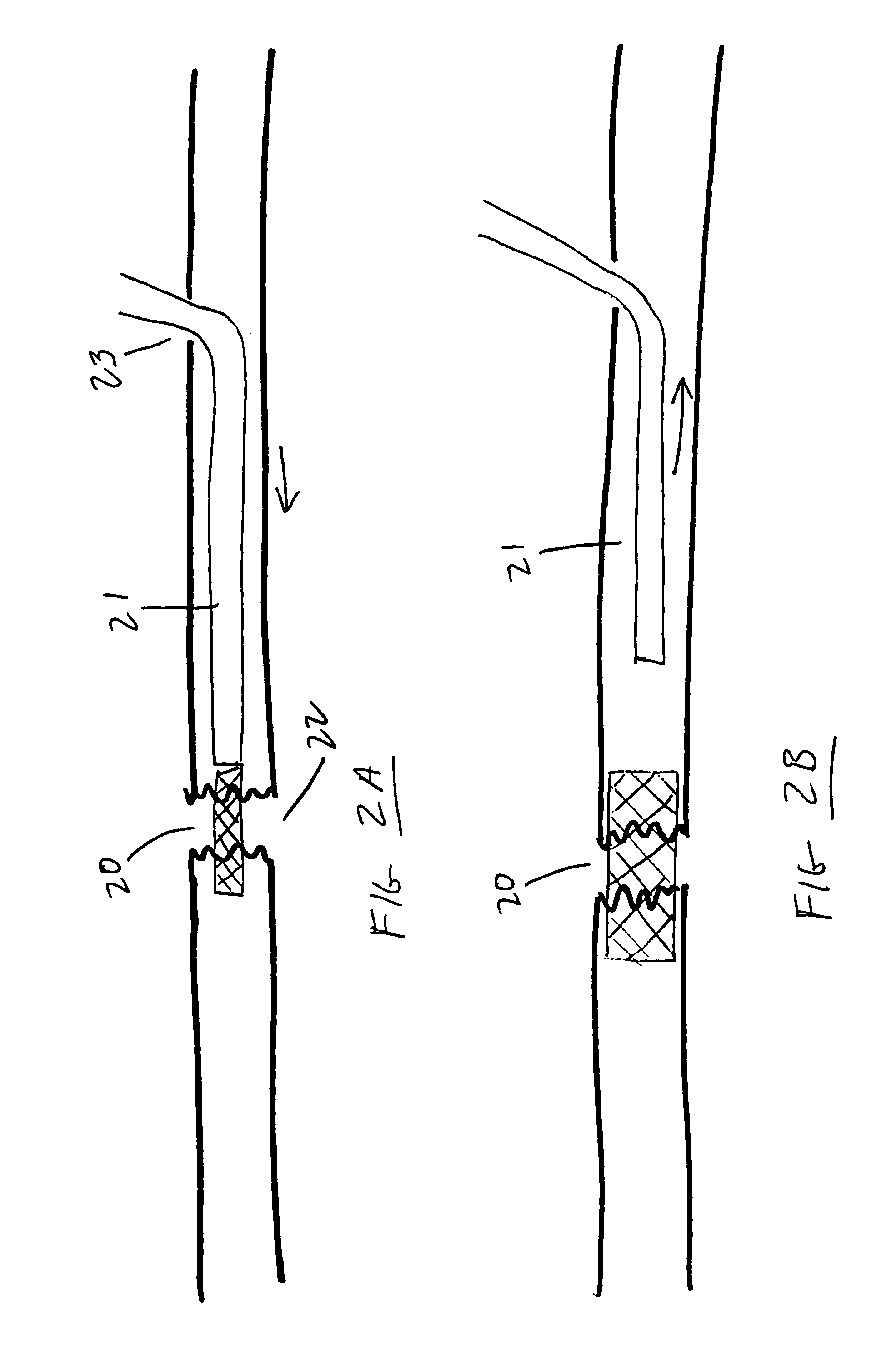 Methods and devices for treatment of bone fractures