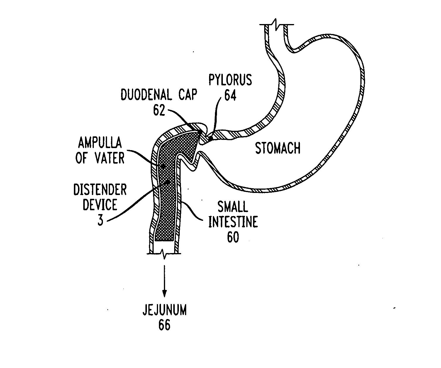 Distender device and method for treatment of obesity and metabolic and other diseases