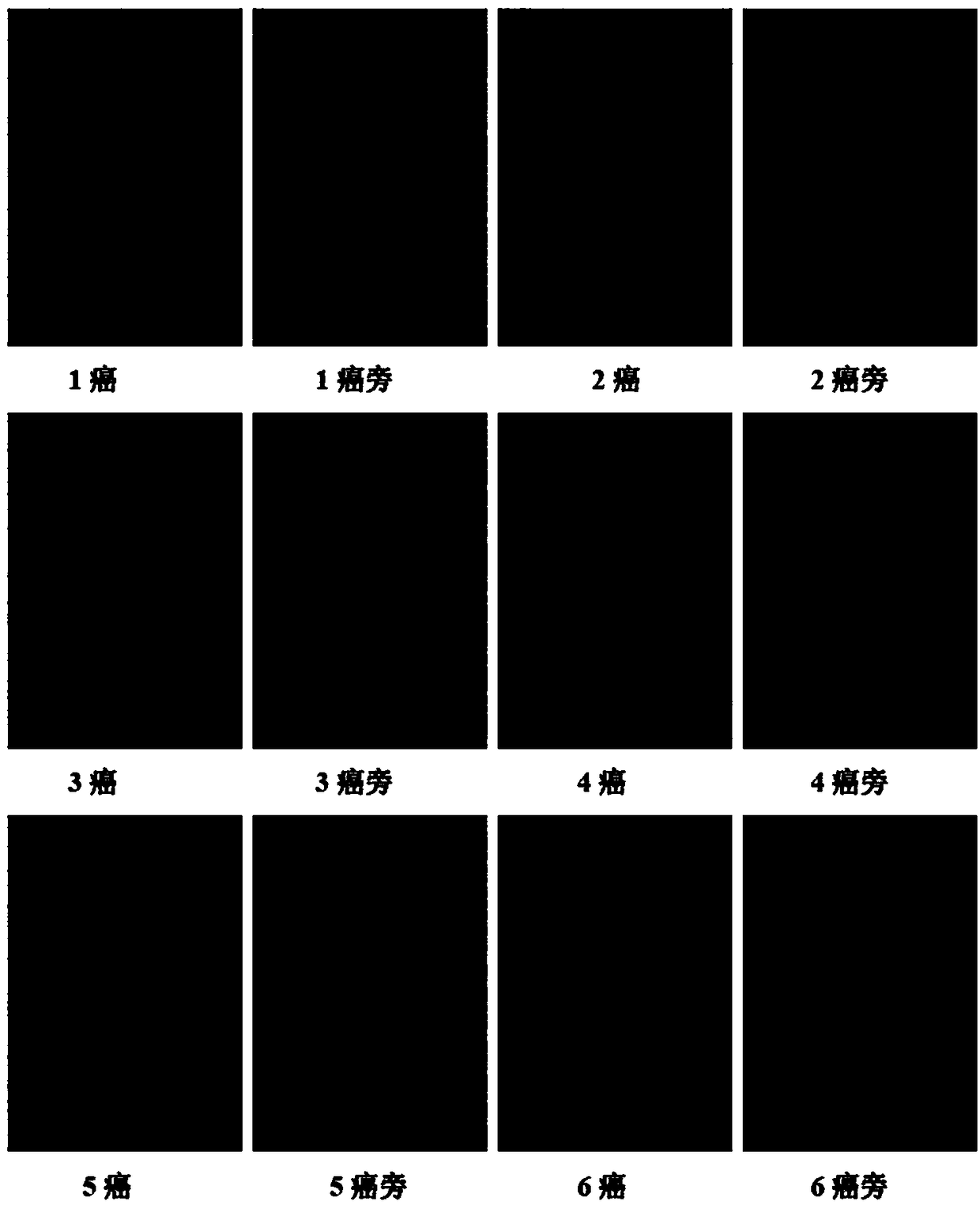 A molecular marker related to nasopharyngeal carcinoma and its application