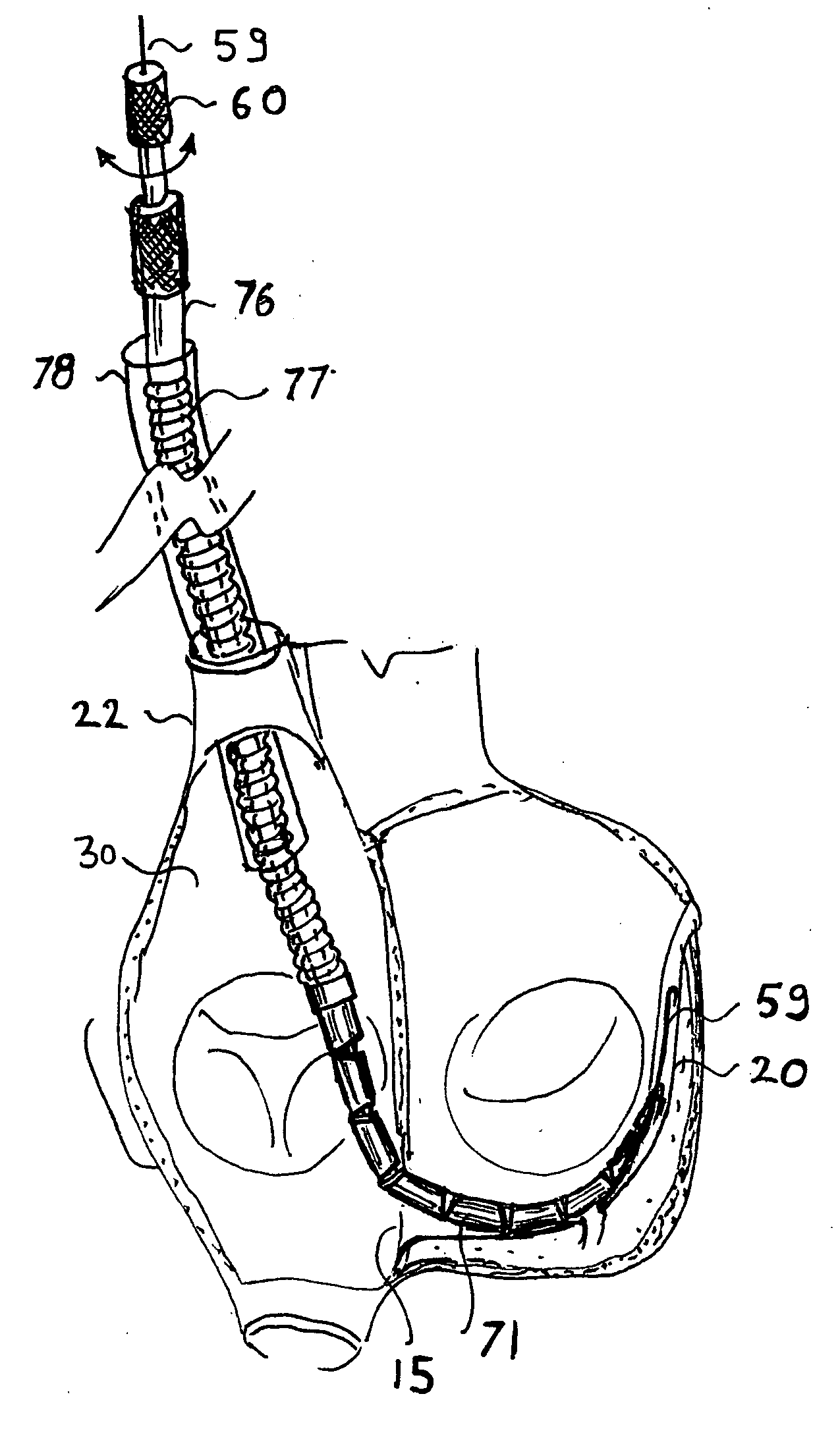 Method and apparatus for percutaneous reduction of anterior-posterior diameter of mitral valve