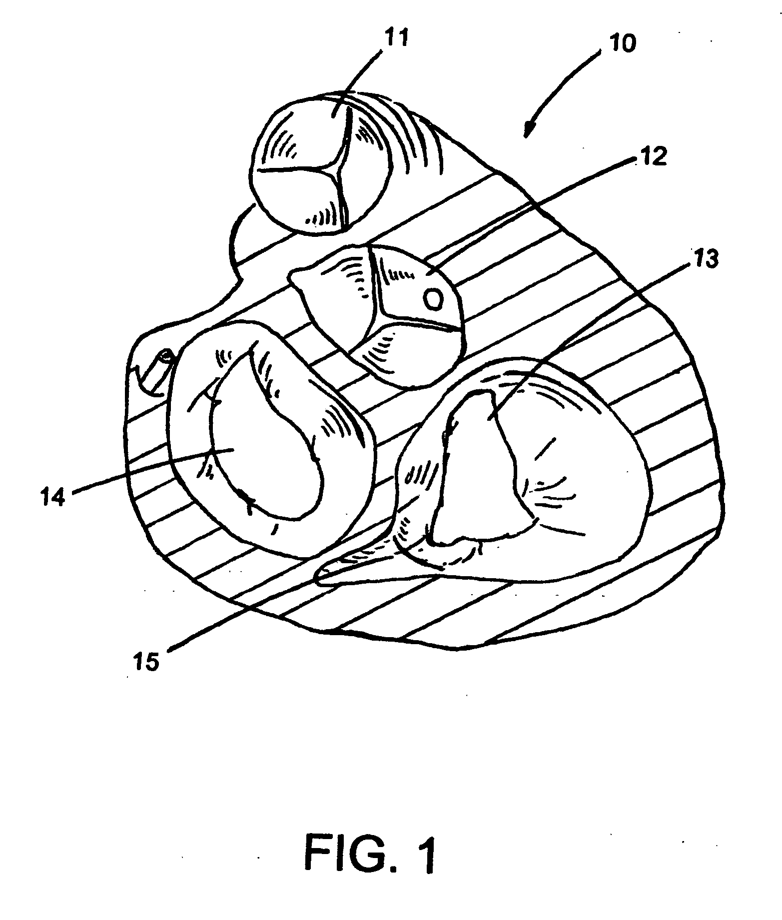 Method and apparatus for percutaneous reduction of anterior-posterior diameter of mitral valve