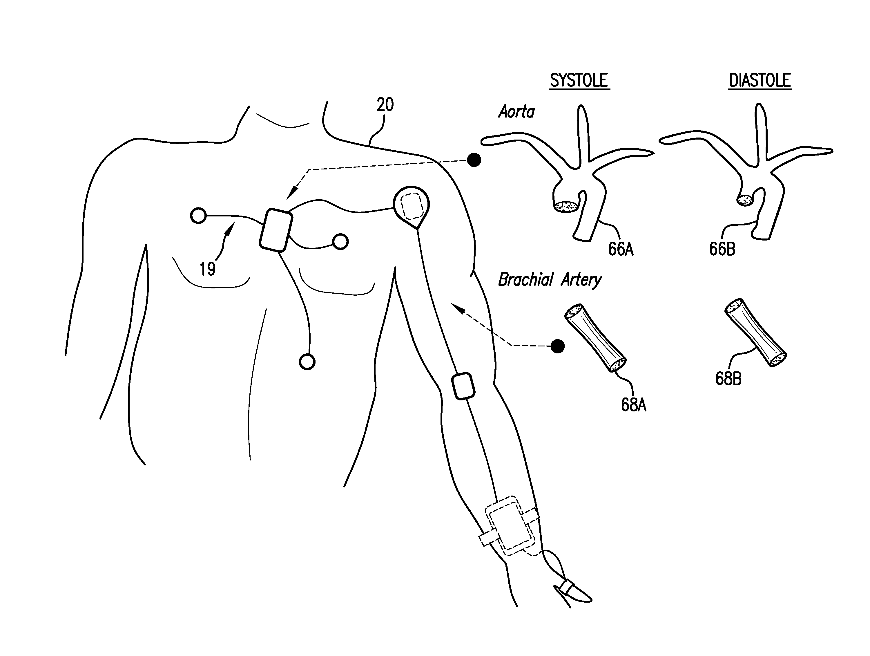 Body-worn system for continuous, noninvasive measurement of cardiac output, stroke volume, cardiac power, and blood pressure