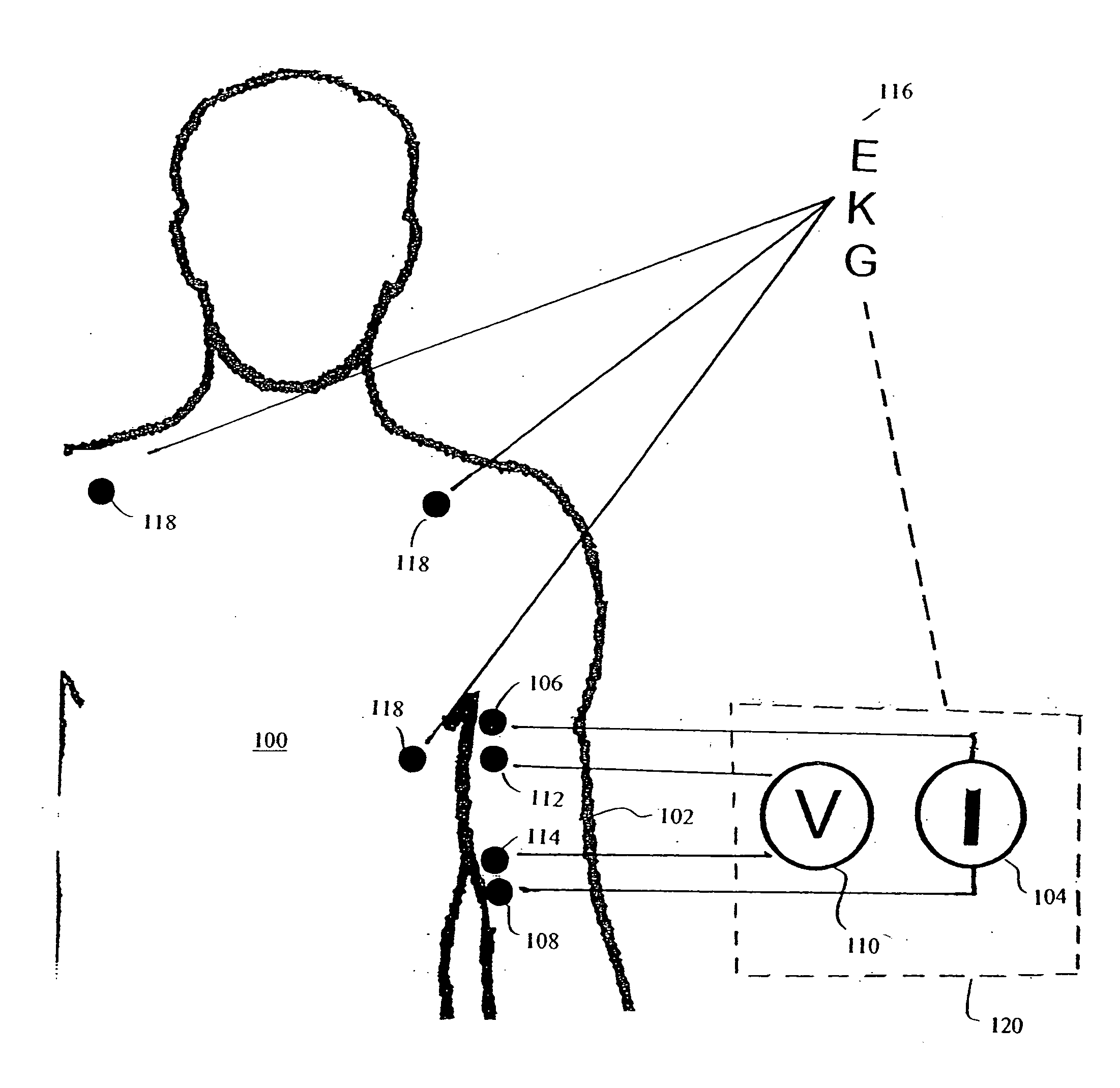 Apparatus and method for determination of stroke volume using the brachial artery