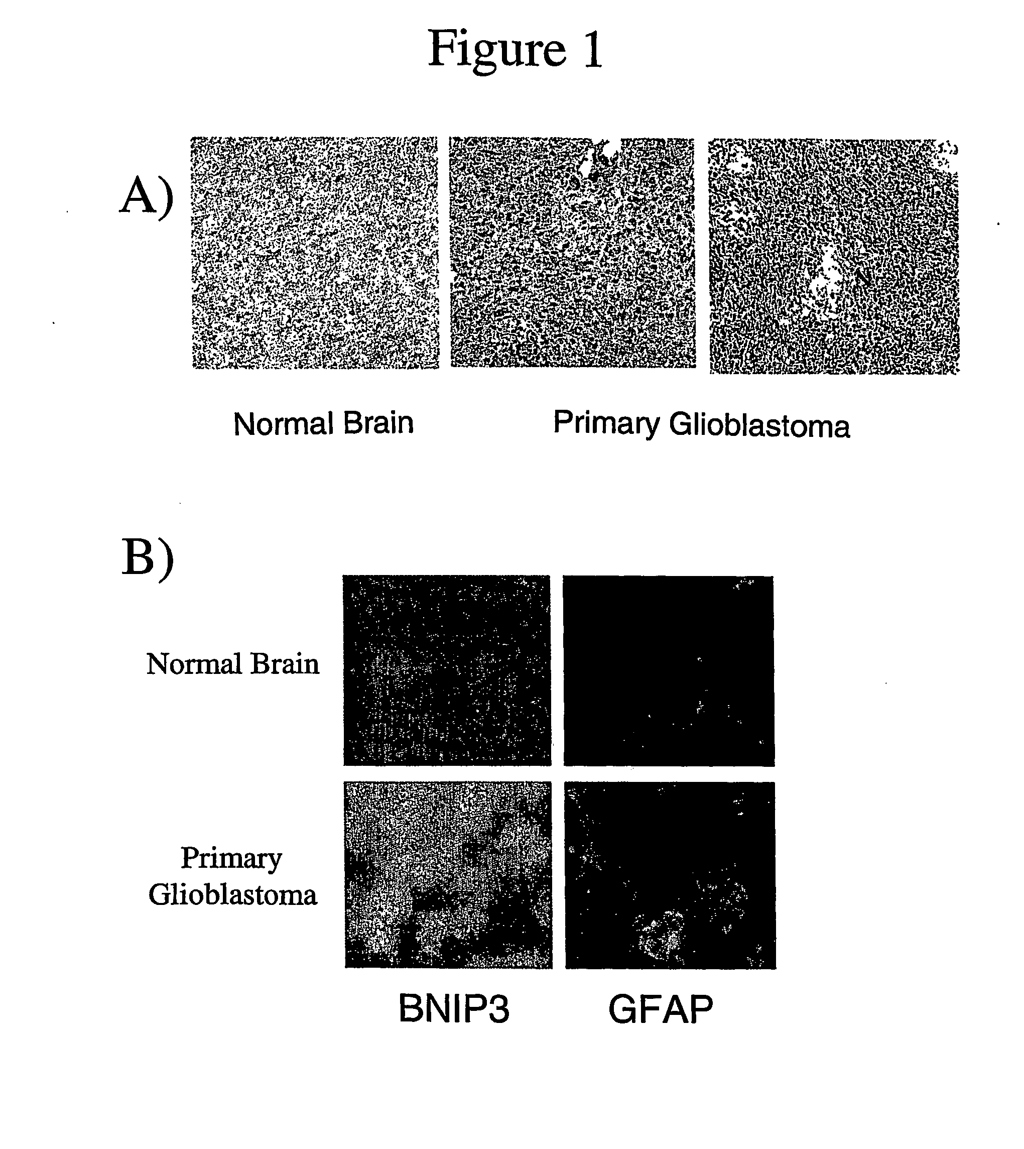 Methods for detecting cancer and monitoring cancer progression