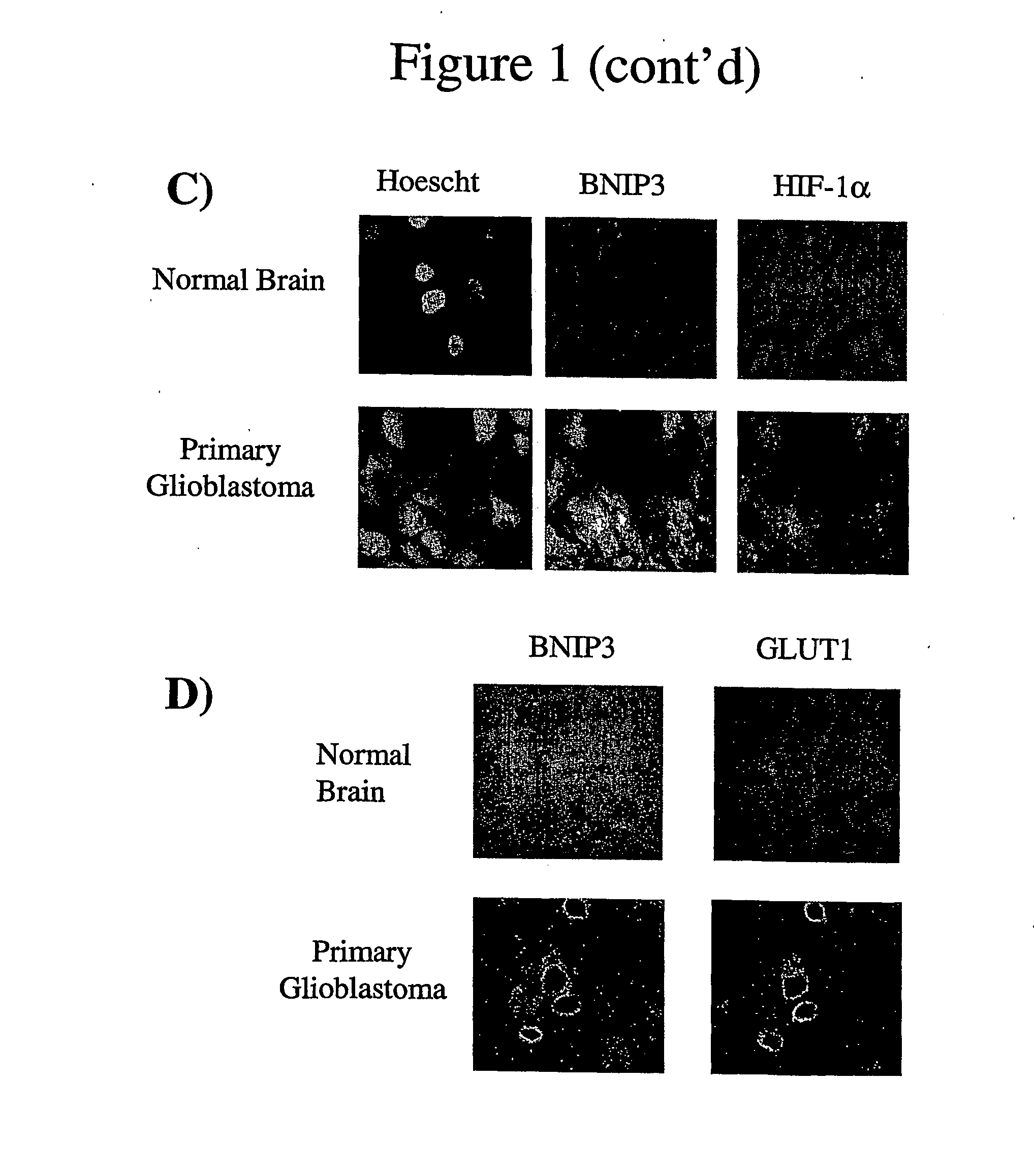 Methods for detecting cancer and monitoring cancer progression