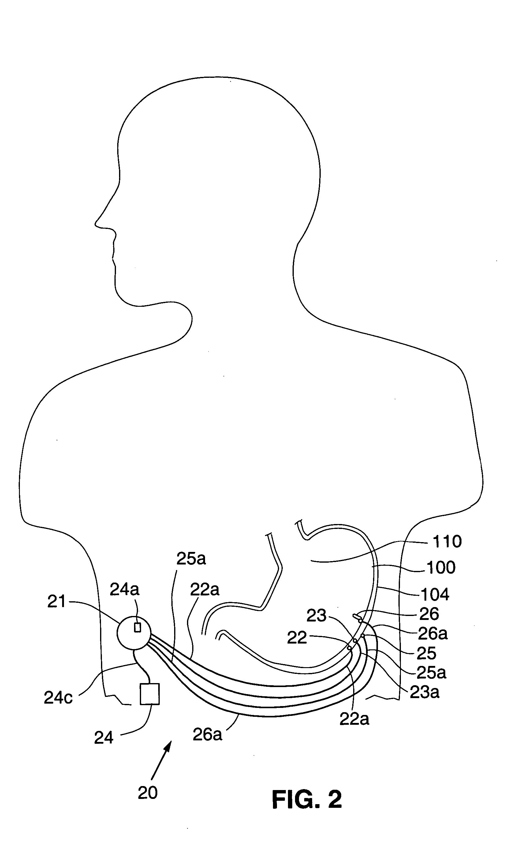 Responsive gastric stimulator