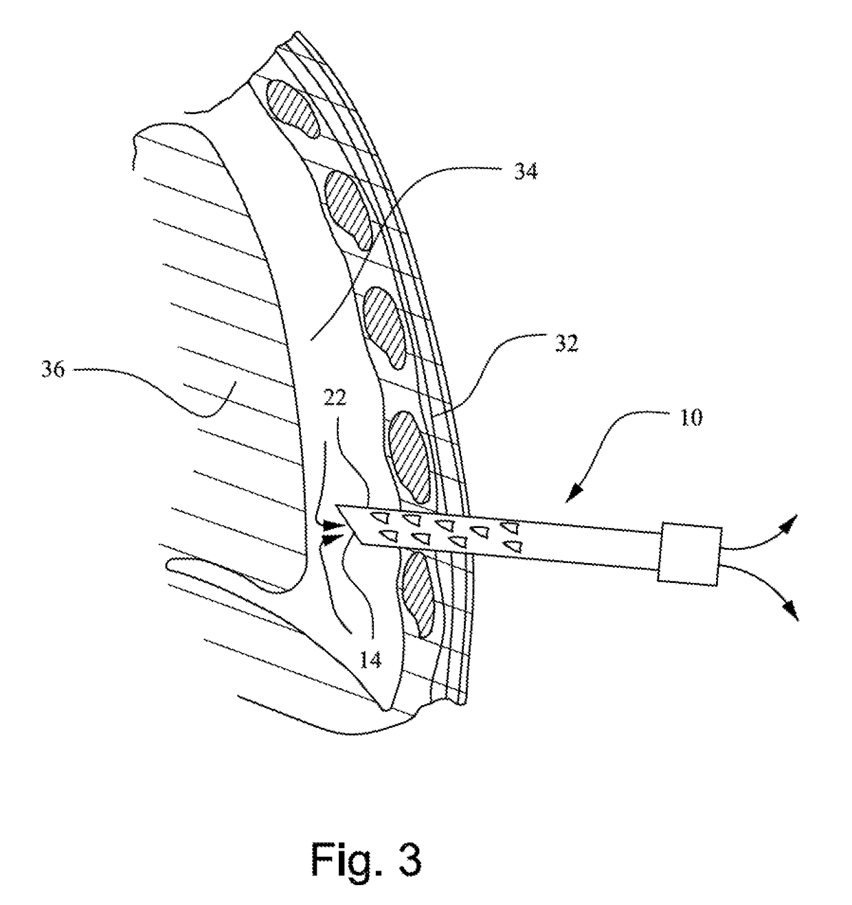 Decompression needle and method for emerency treatment of a pneumothorax