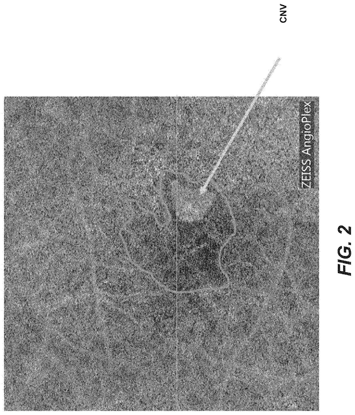 Non-leaking or minimally-leaking choroidal or retinal revascularization