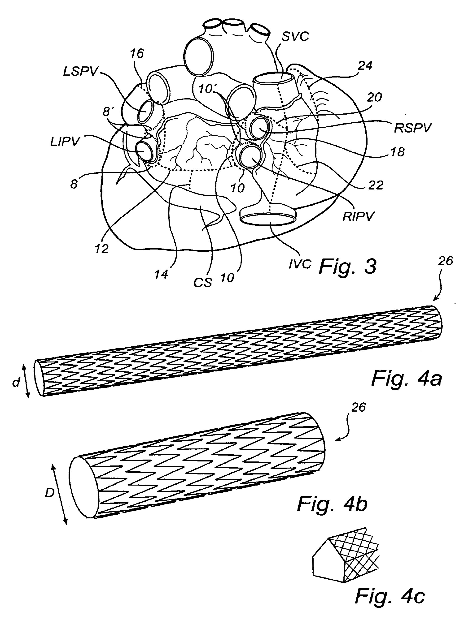 Device, A Kit And A Method For Treatment Of Disorders In The Heart Rhythm Regulation System