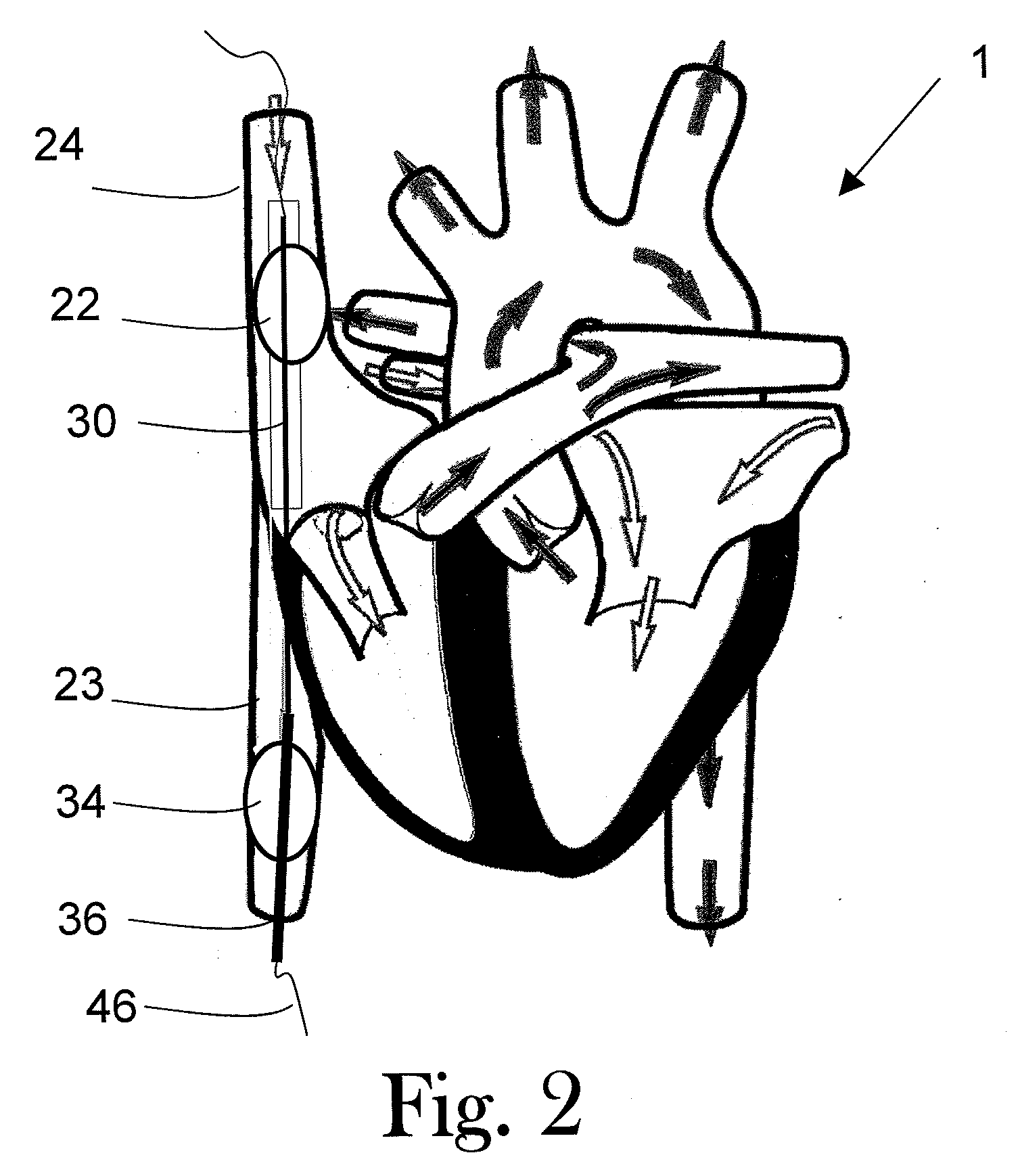 Method for controlling the systemic pressure in cardiac operations