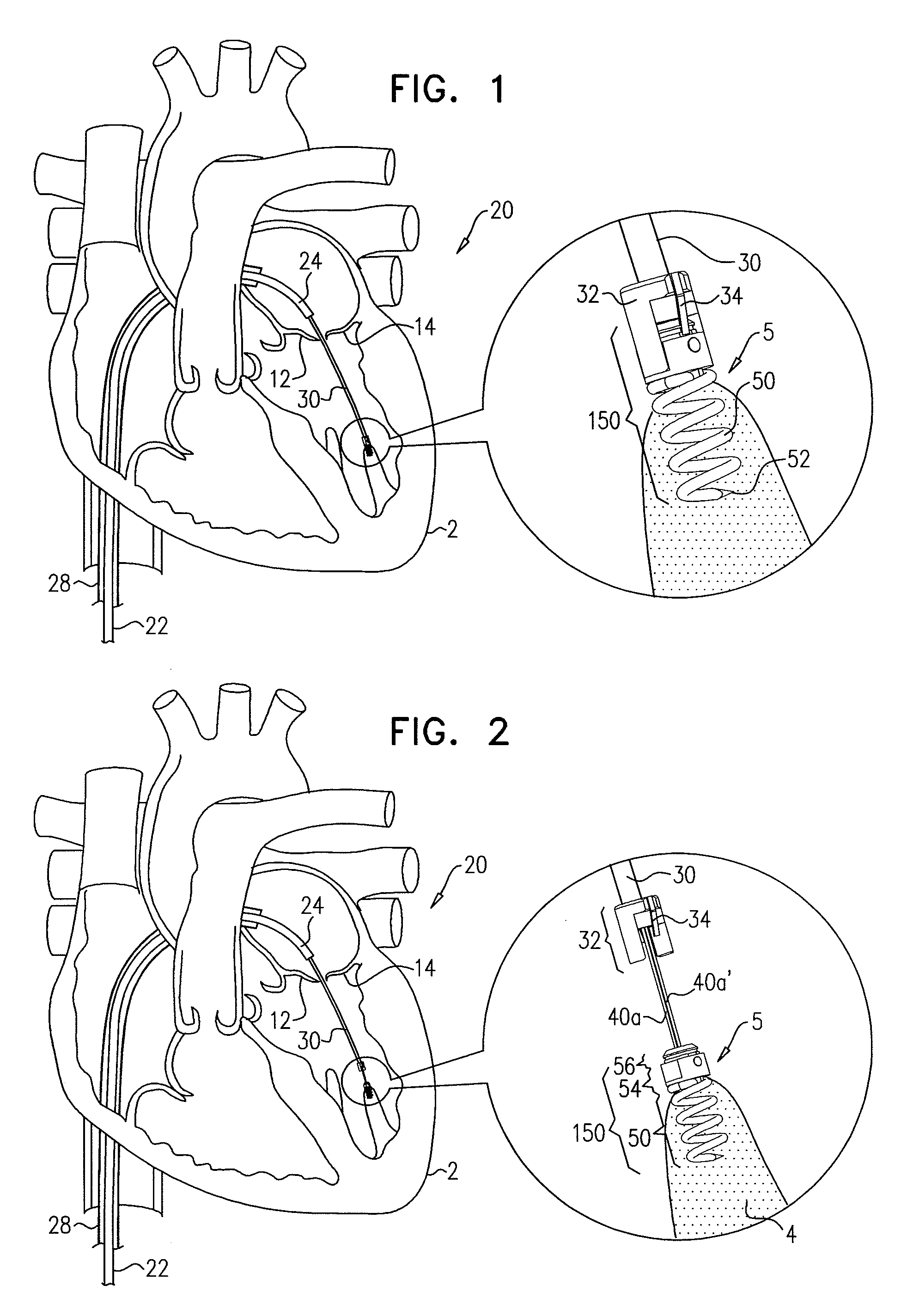 Method for guide-wire based advancement of a rotation assembly