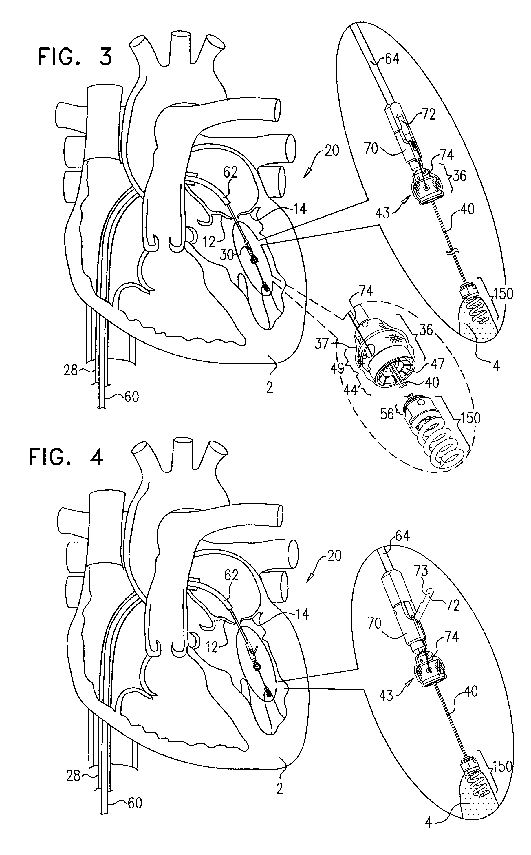 Method for guide-wire based advancement of a rotation assembly