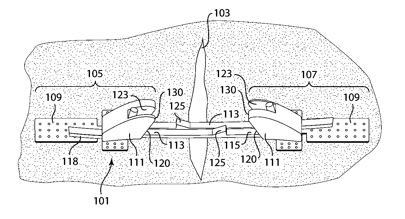 Devices for Securely Closing Tissue Openings with Minimized Scarring