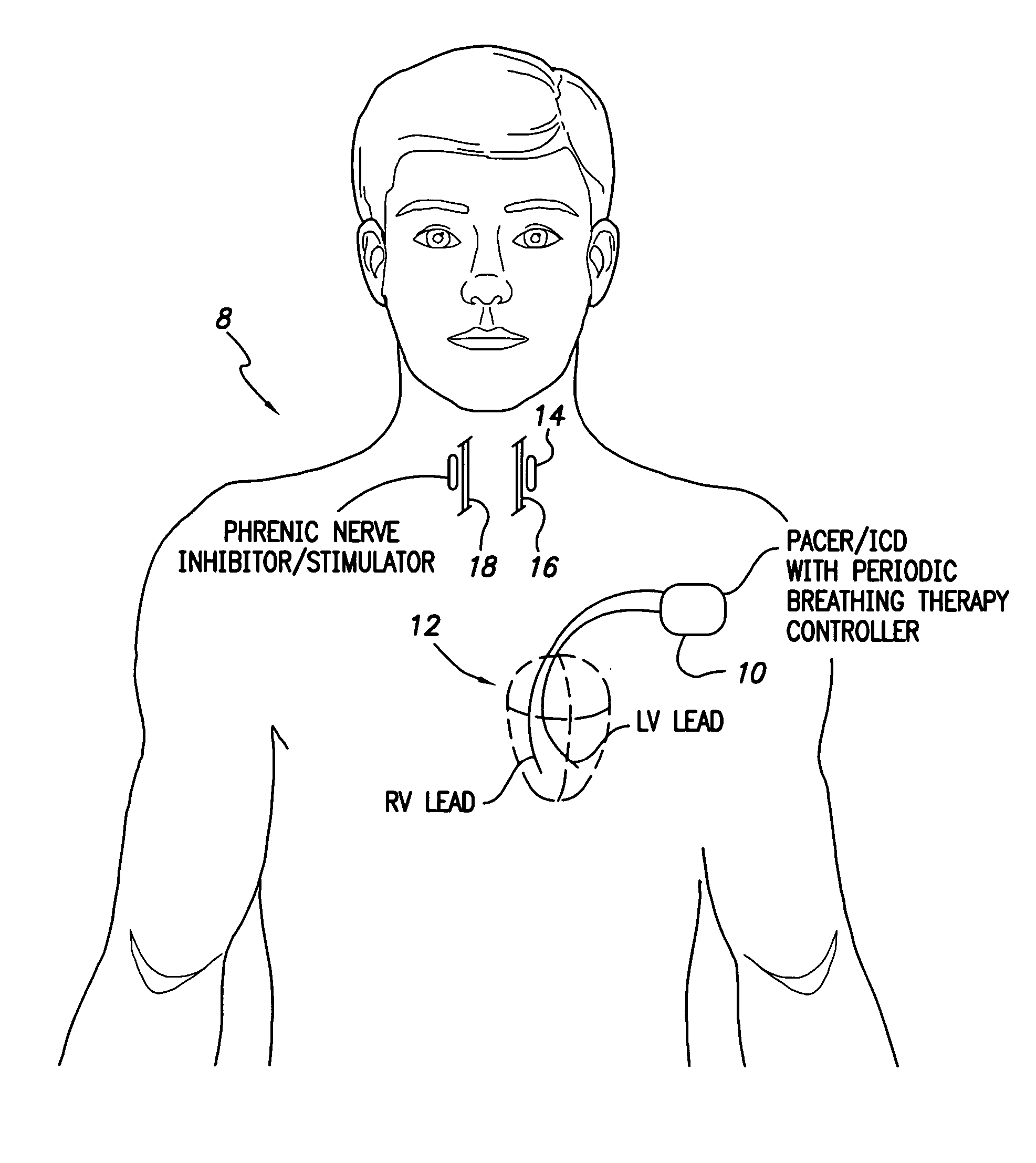 System and method for applying therapy during hyperpnea phase of periodic breathing using an implantable medical device