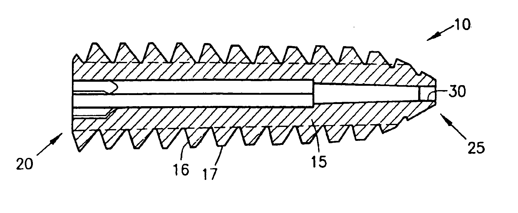 Tapered bioabsorbable interference screw for endosteal fixation of ligaments