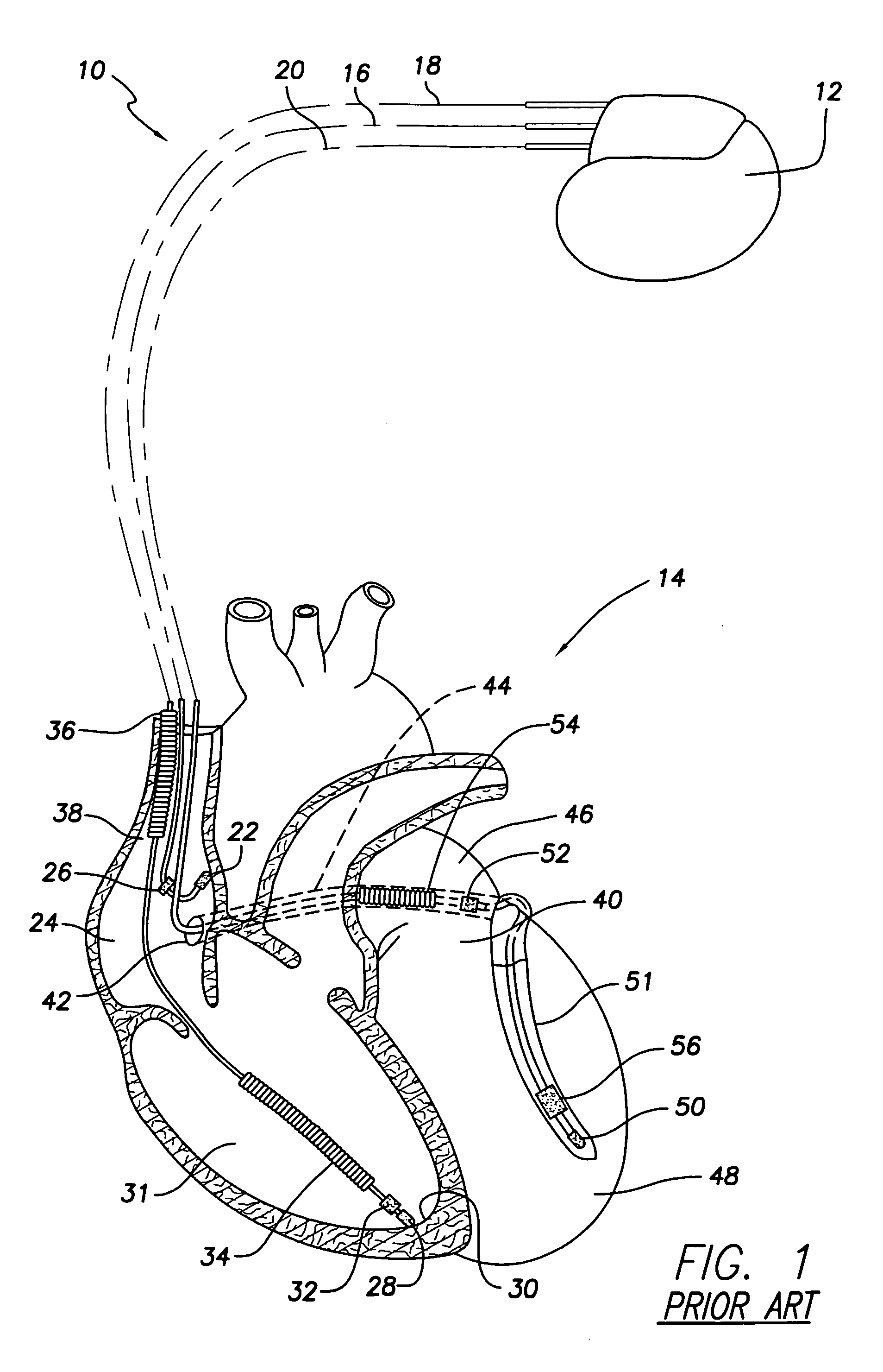 Medical lead with tissue-protecting tip structure