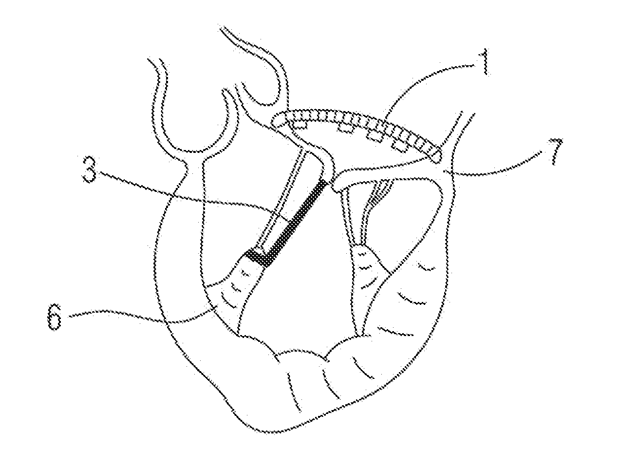 Prosthetic band, in particular for repairing a mitral valve