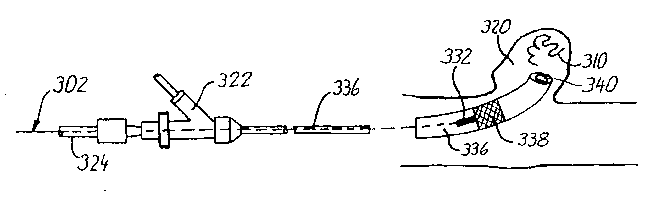 Endovascular medical device with plurality of wires