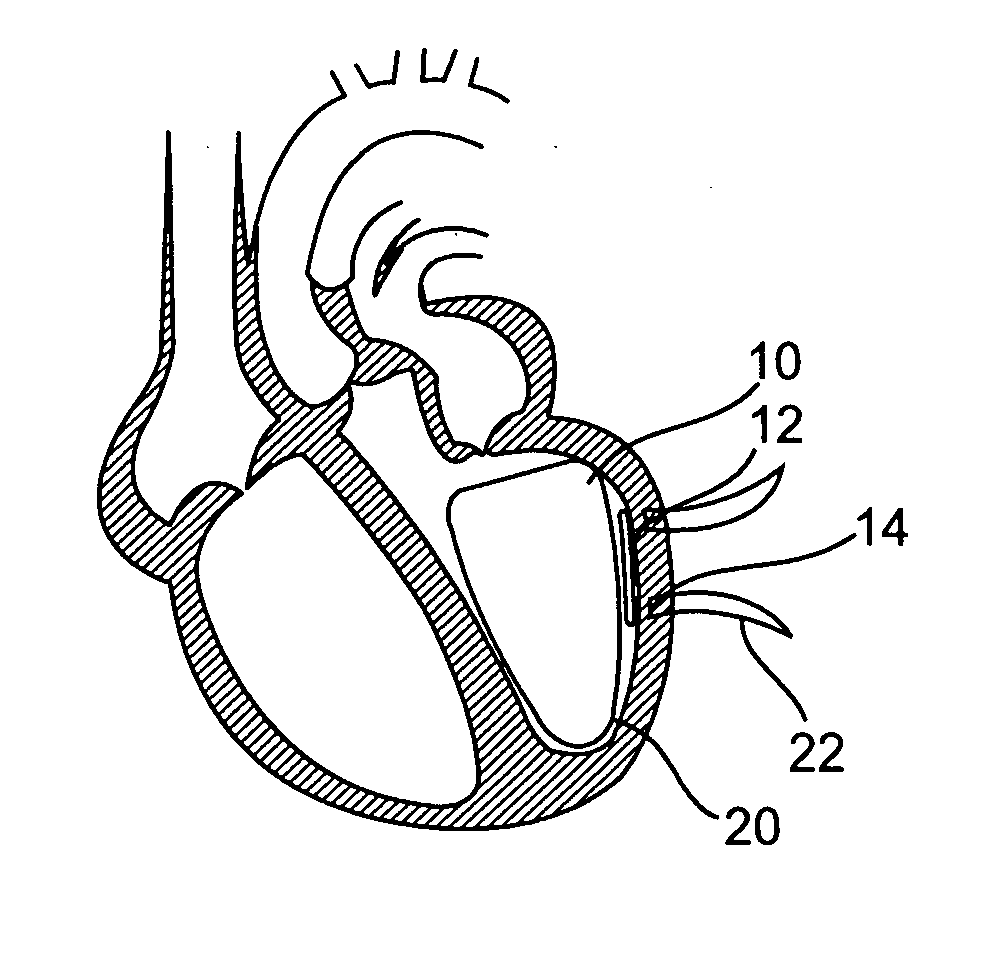 Sizing and shaping device for treating congestive heart failure