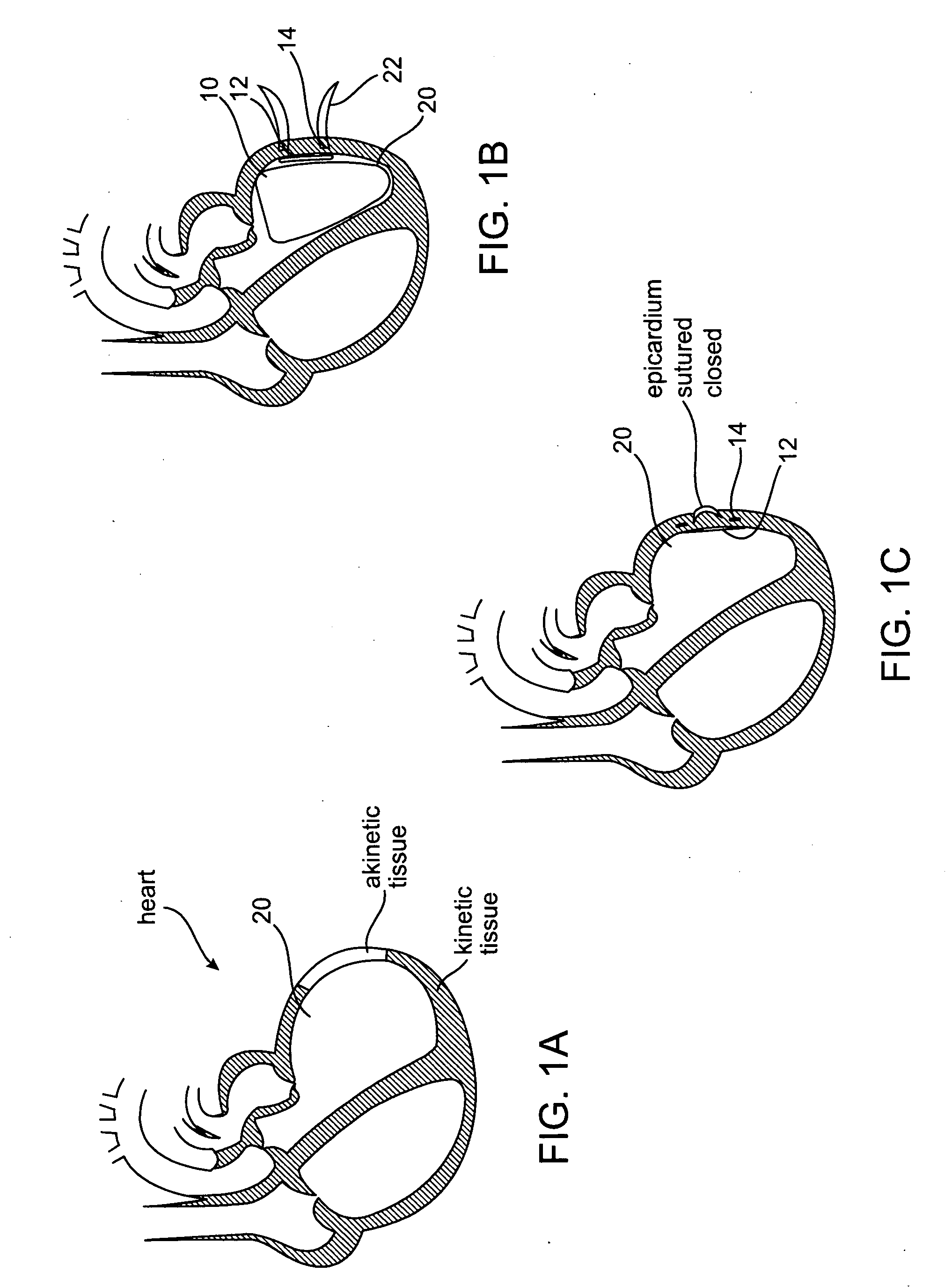 Sizing and shaping device for treating congestive heart failure