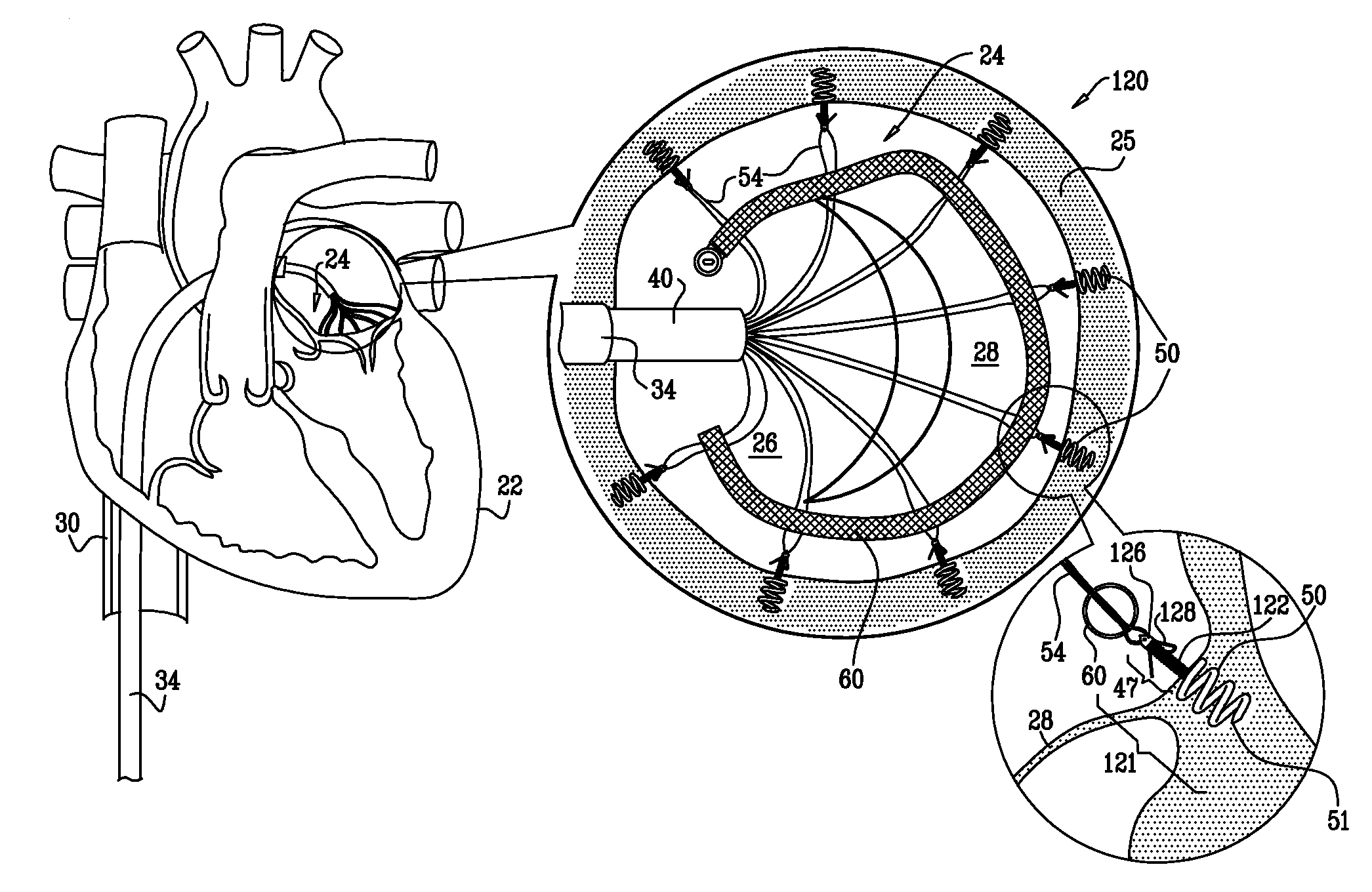 Tissue anchor for annuloplasty device