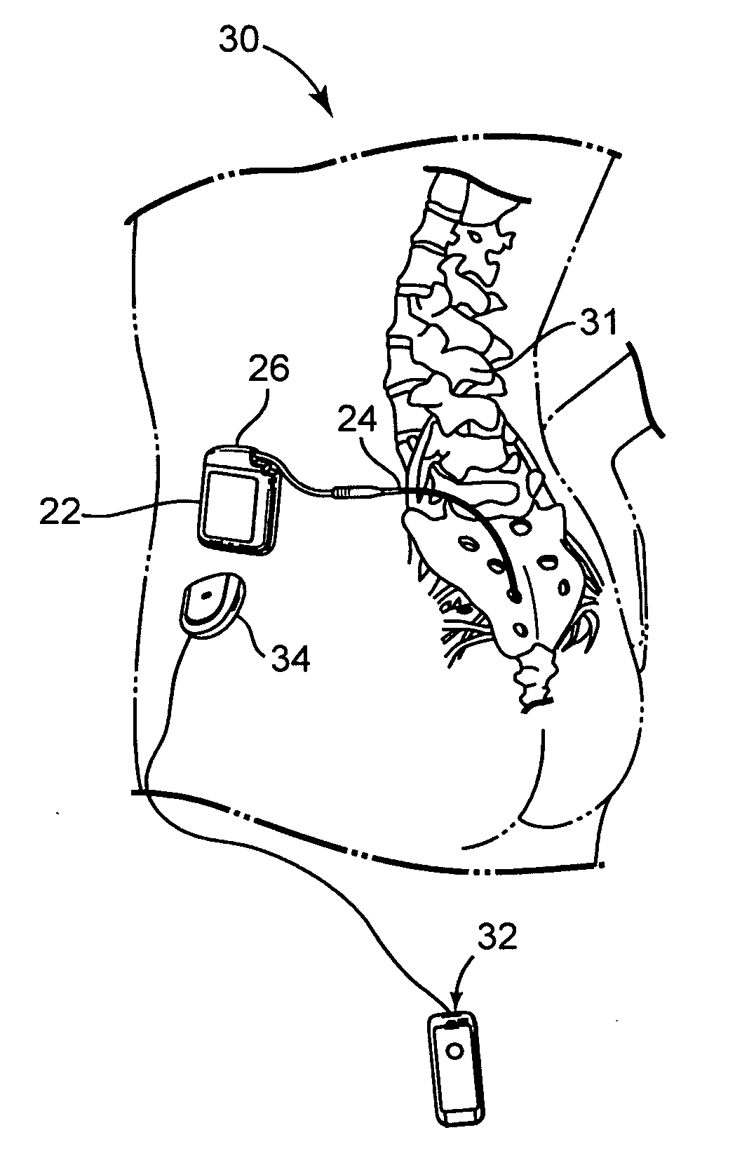 Controller for obtaining prescriptive analysis of functionality of implantable medical device leads, system and method therefore