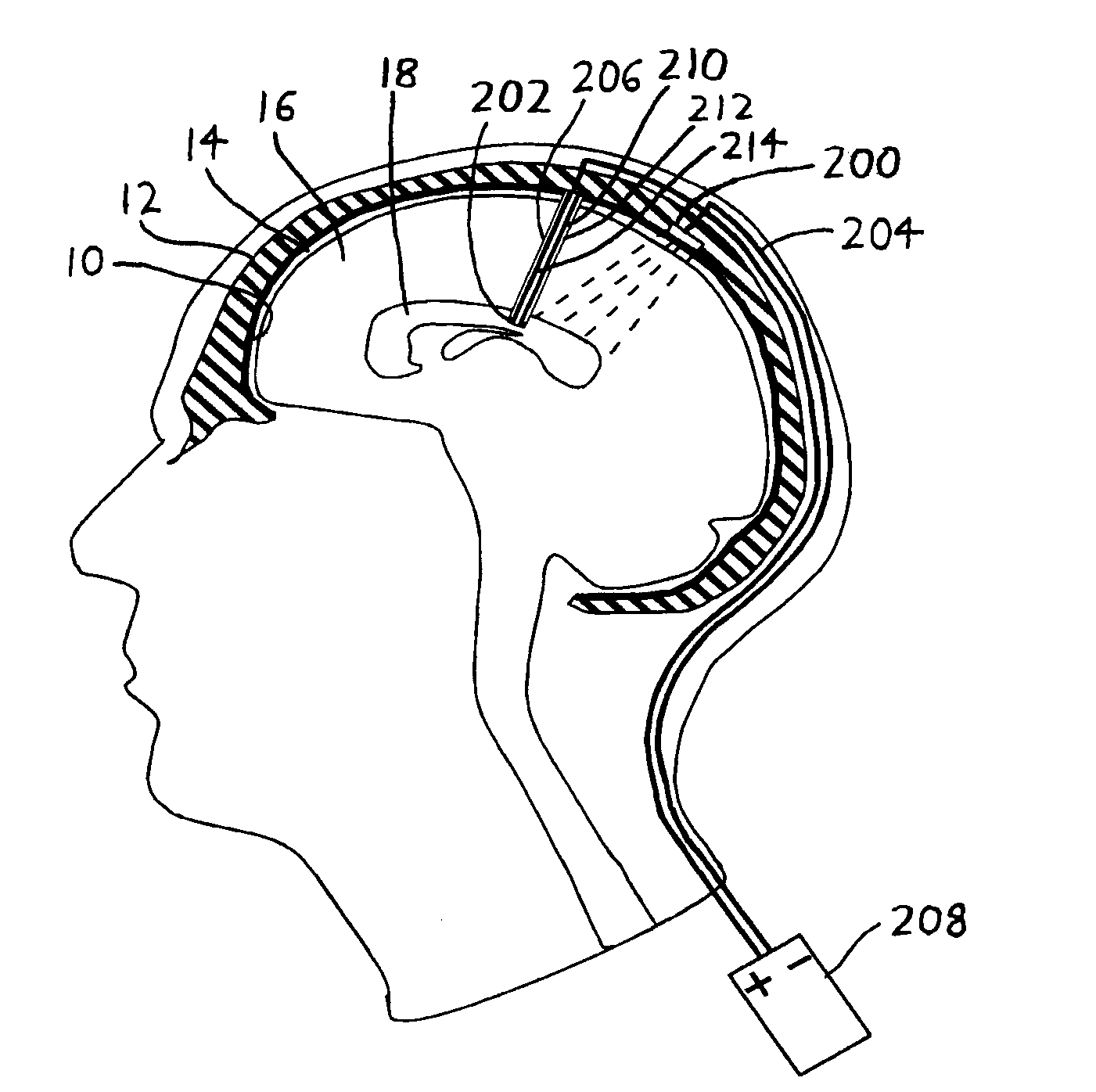 Intraventricular electrodes for electrical stimulation of the brain