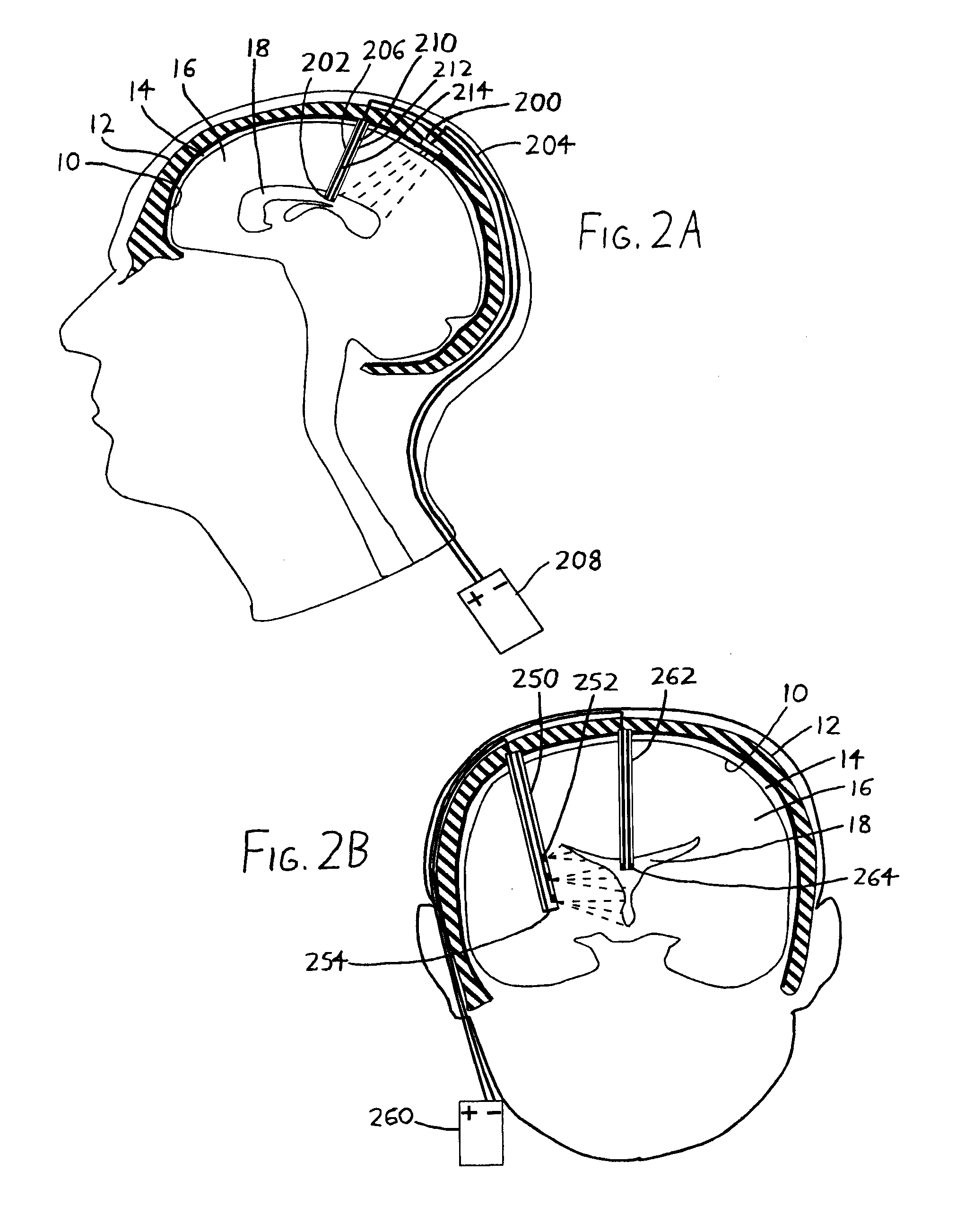 Intraventricular electrodes for electrical stimulation of the brain