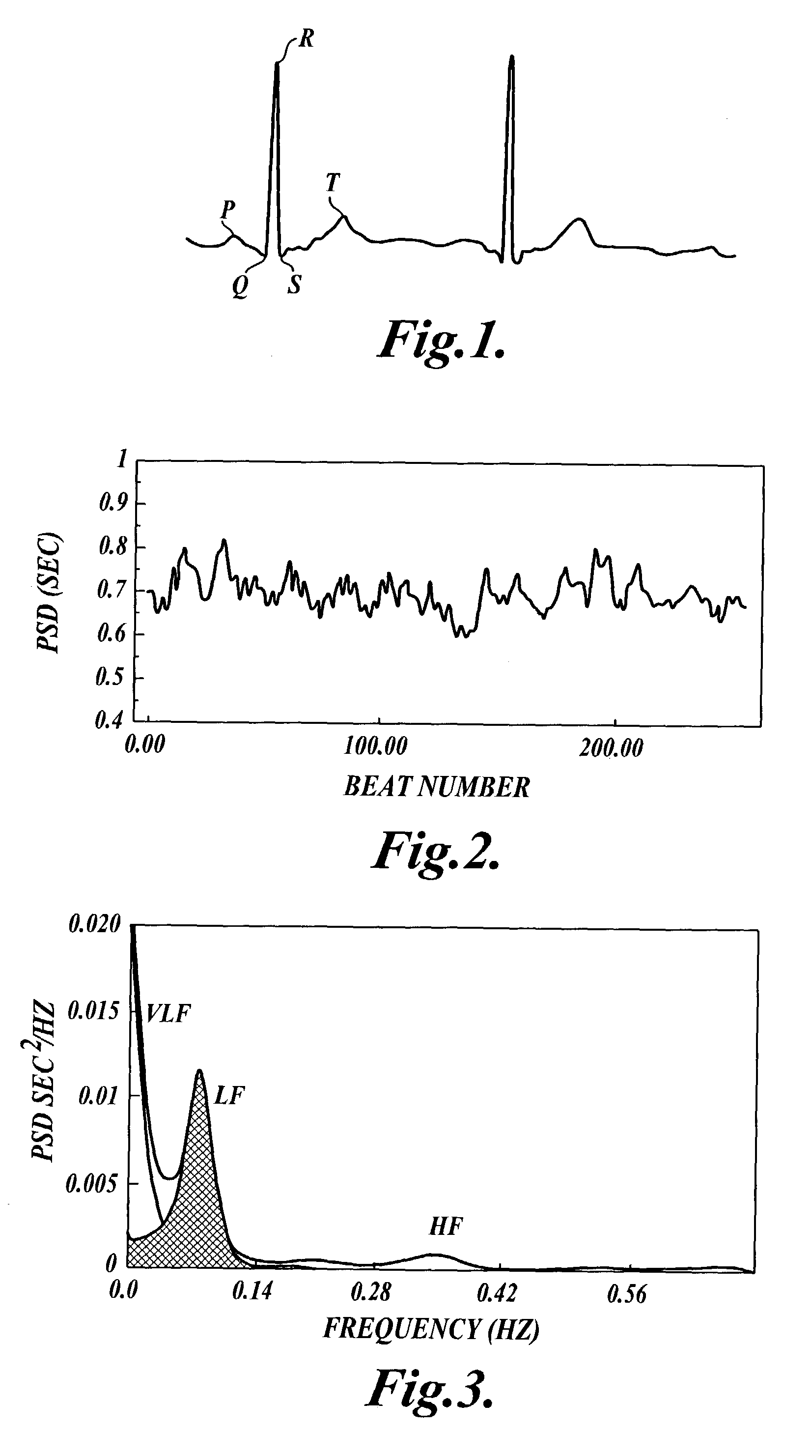 Methods for determining whether to provide an inhibitor of sympathetic nervous system activity to a human being suffering from an autoimmune disease or fibryomyalgia