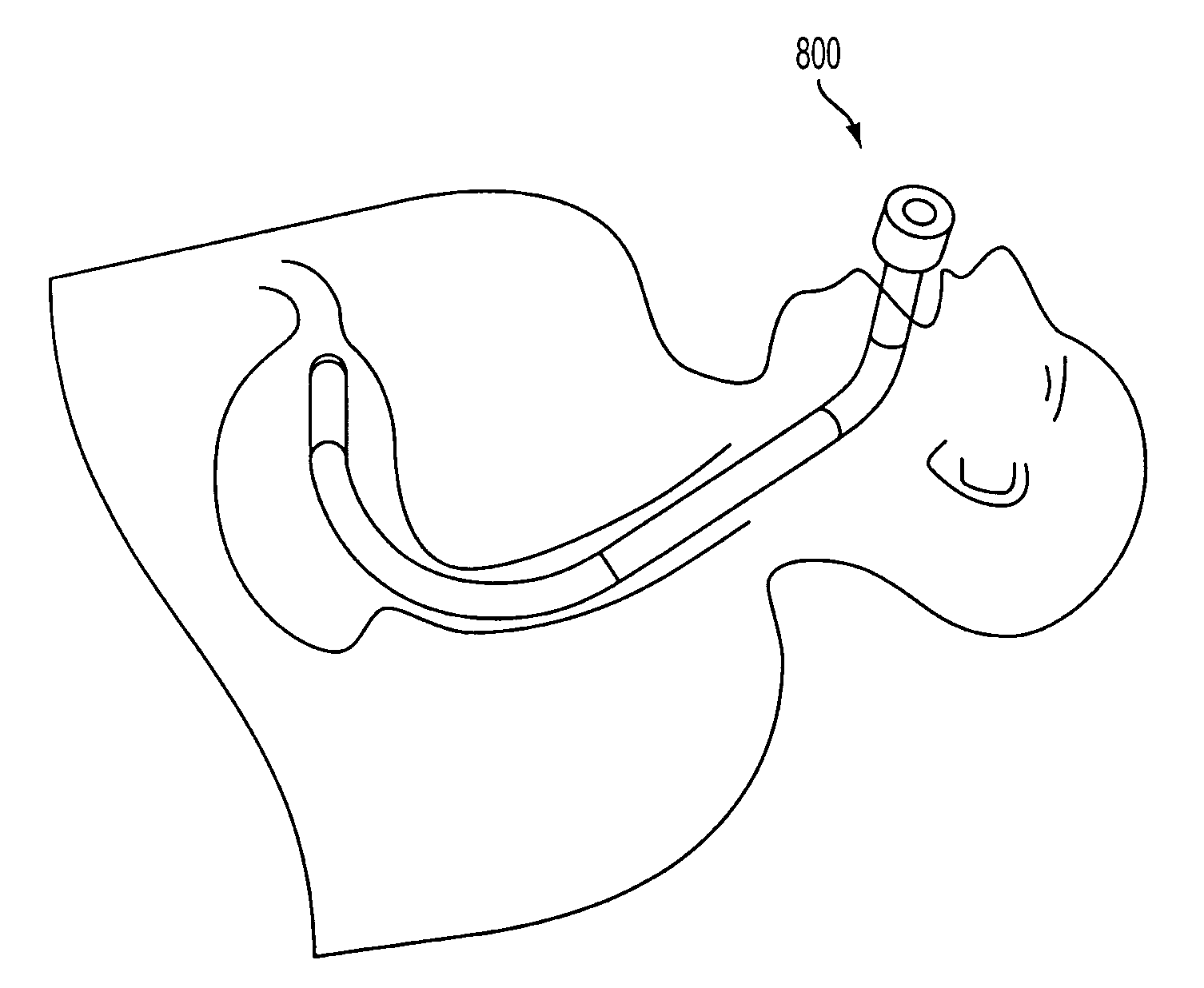 Endoluminal and transluminal surgical methods and devices