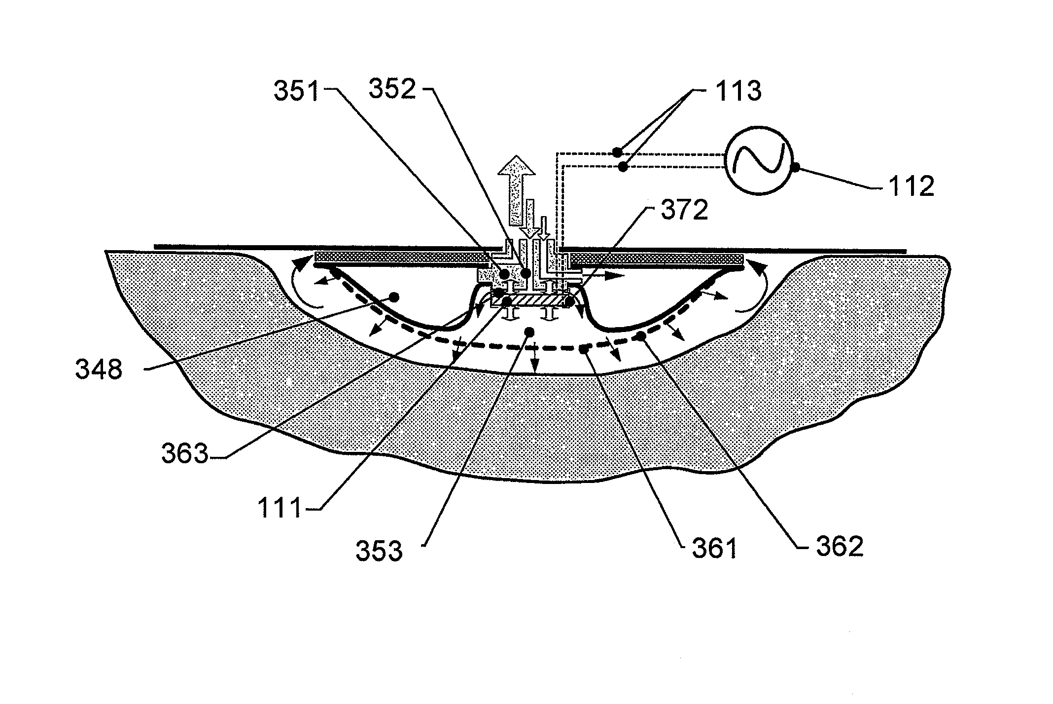 Wound treatment apparatus and method