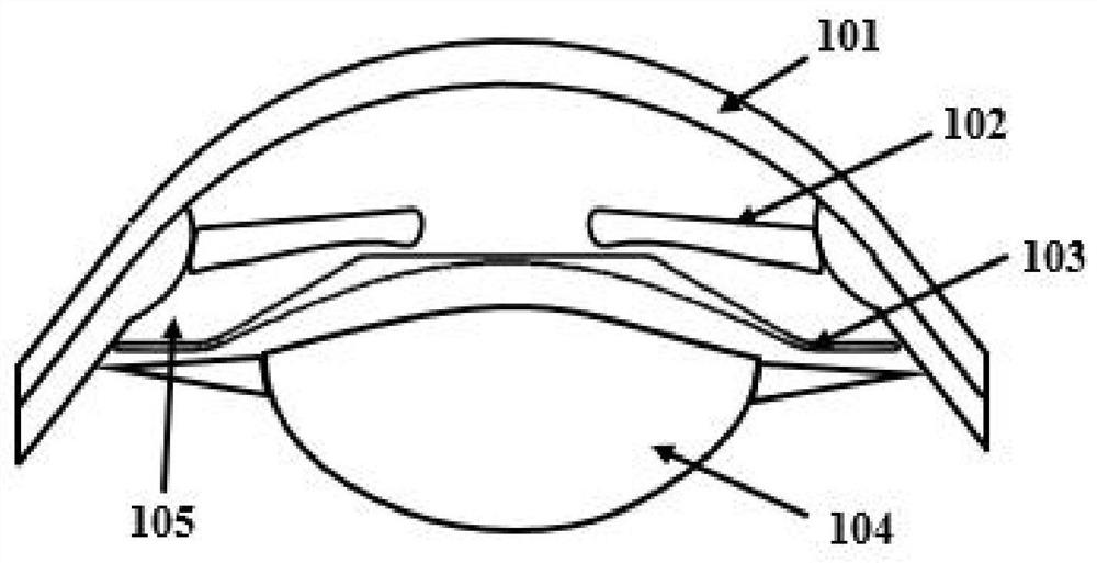 Posterior chamber type progressive multi-focus intraocular lens with lens eye