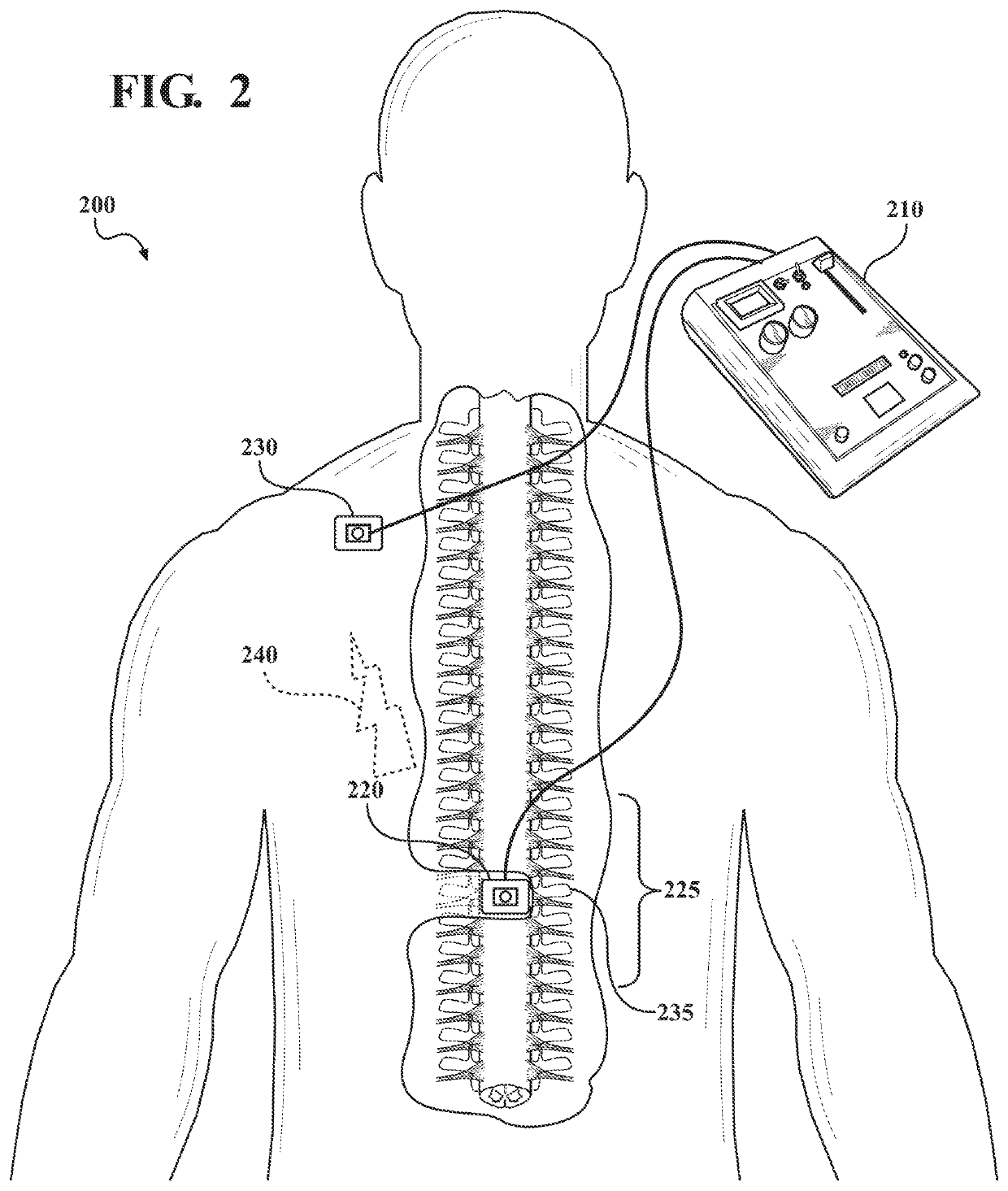 Transcutaneous spinal cord stimulation for treatment of psychiatric disorders