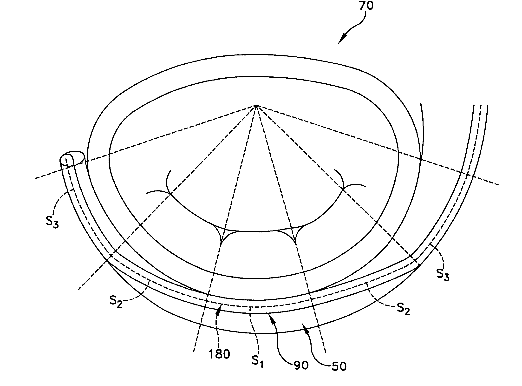 Method and apparatus for improving mitral valve function