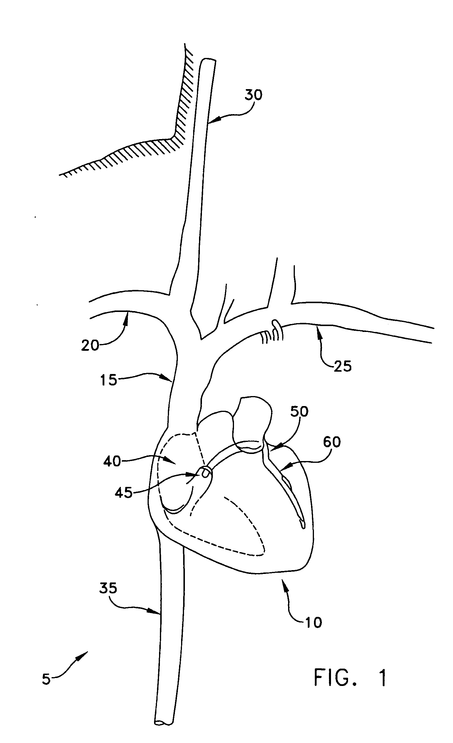 Method and apparatus for improving mitral valve function